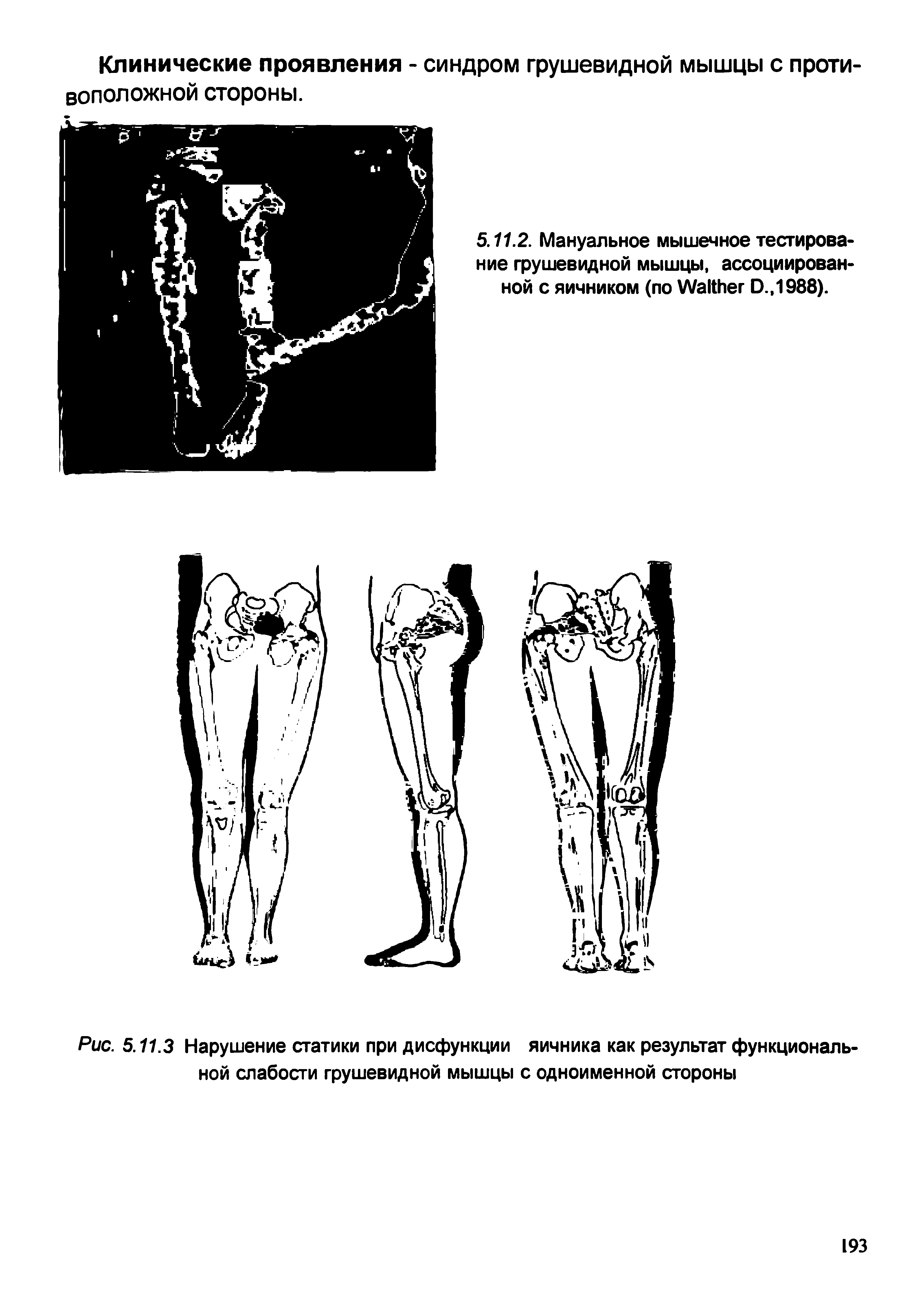 Рис. 5.11.3 Нарушение статики при дисфункции яичника как результат функциональной слабости грушевидной мышцы с одноименной стороны...