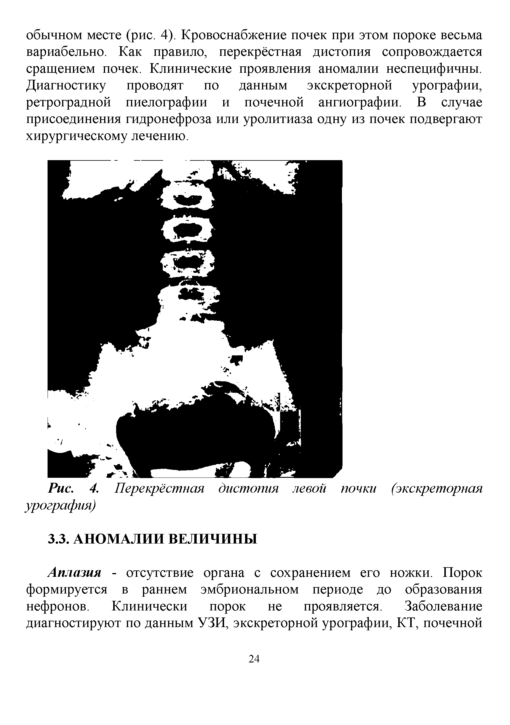 Рис. 4. Перекрёстная дистопия левой почки (экскреторная урография)...