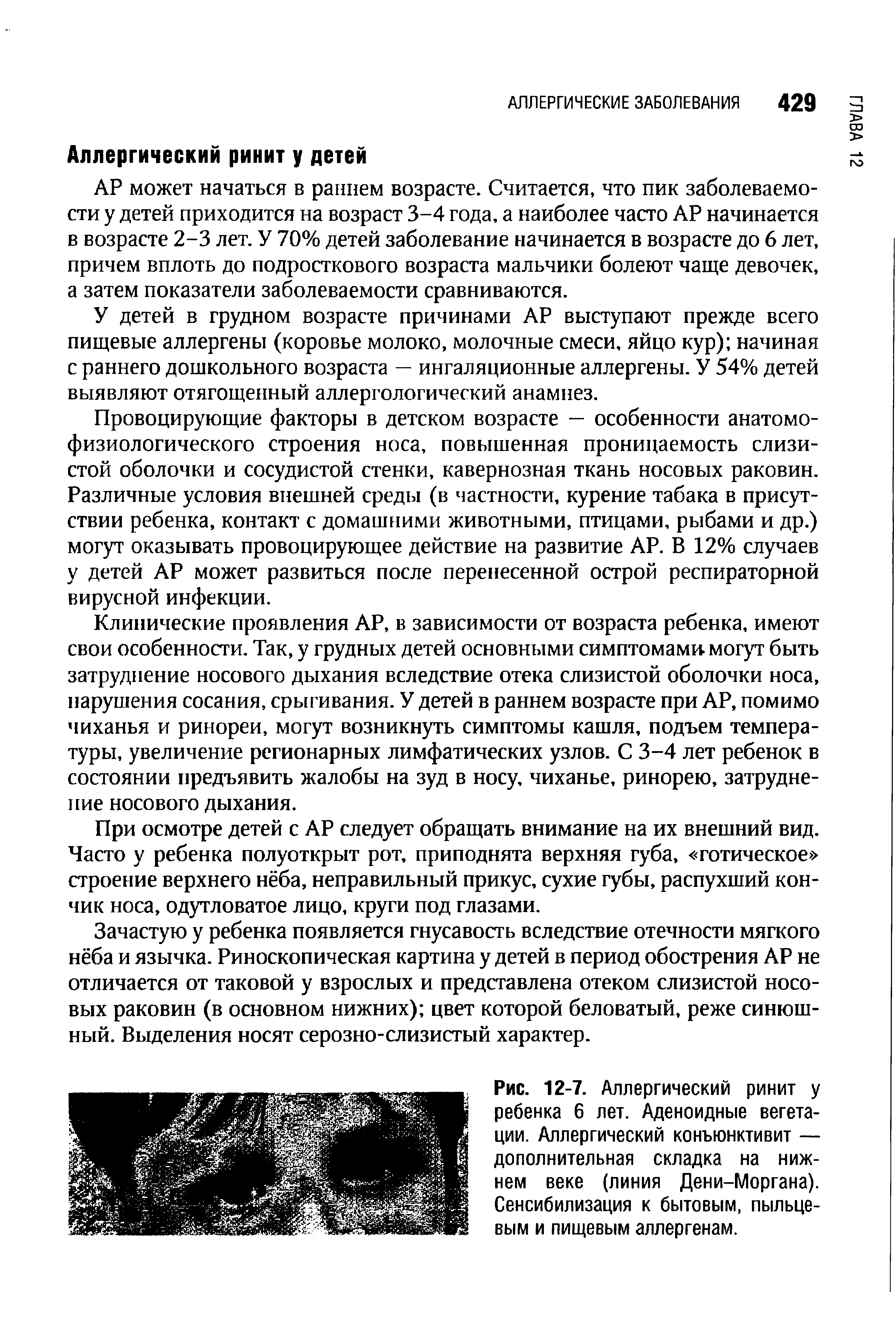 Рис. 12-7. Аллергический ринит у ребенка 6 лет. Аденоидные вегетации. Аллергический конъюнктивит — дополнительная складка на нижнем веке (линия Дени-Моргана). Сенсибилизация к бытовым, пыльцевым и пищевым аллергенам.