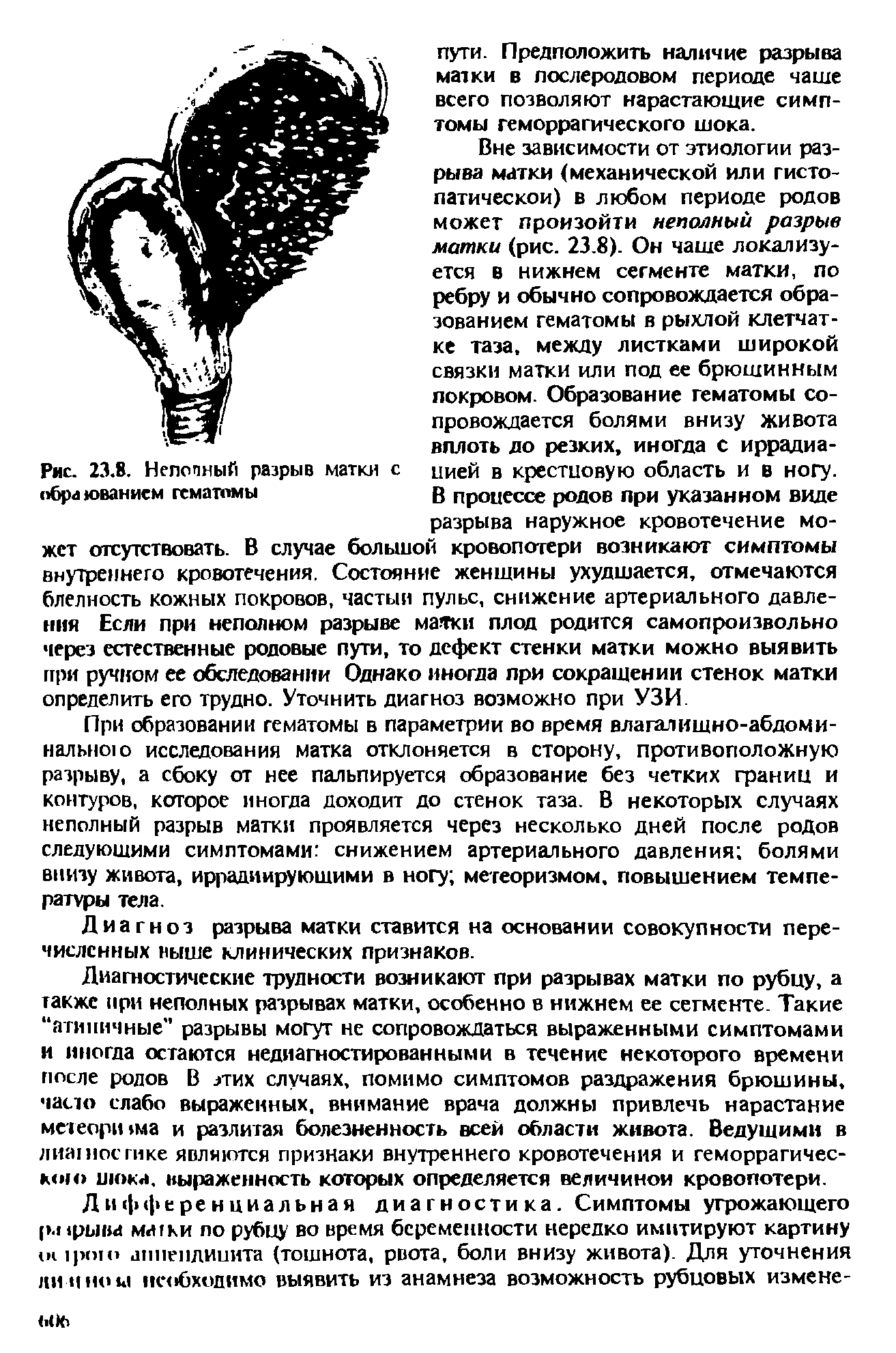 Рис. 23.8. Неполный разрыв матки с цией в крестцовую область и в ногу, образованием гематомы В процессе родов при указанном виде...