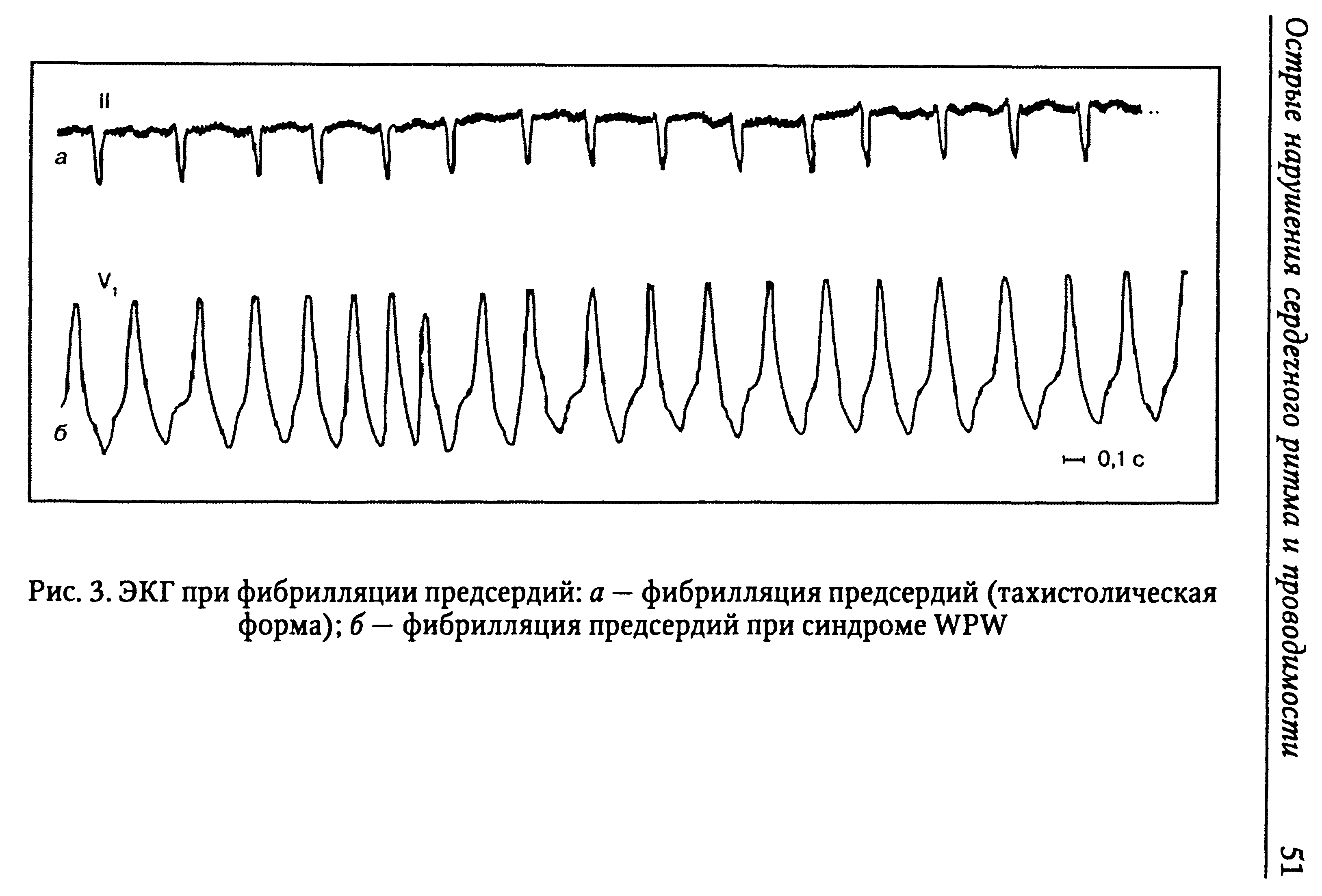 Рис. 3. ЭКГ при фибрилляции предсердий а — фибрилляция предсердий (тахистолическая форма) б — фибрилляция предсердий при синдроме WPW...