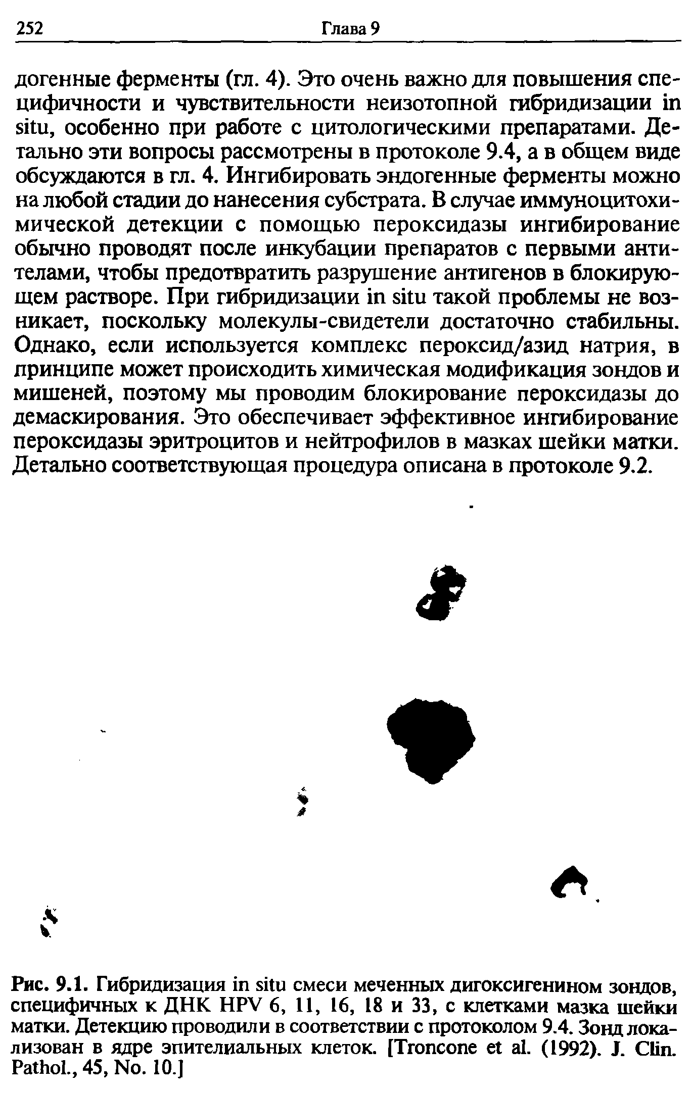 Рис. 9.1. Гибридизация смеси меченных дигоксигенином зондов, специфичных к ДНК HPV 6, 11, 16, 18 и 33, с клетками мазка шейки матки. Детекцию проводили в соответствии с протоколом 9.4. Зонд локализован в ядре эпителиальных клеток. [T . (1992). J. C . P ., 45, N . 10.]...