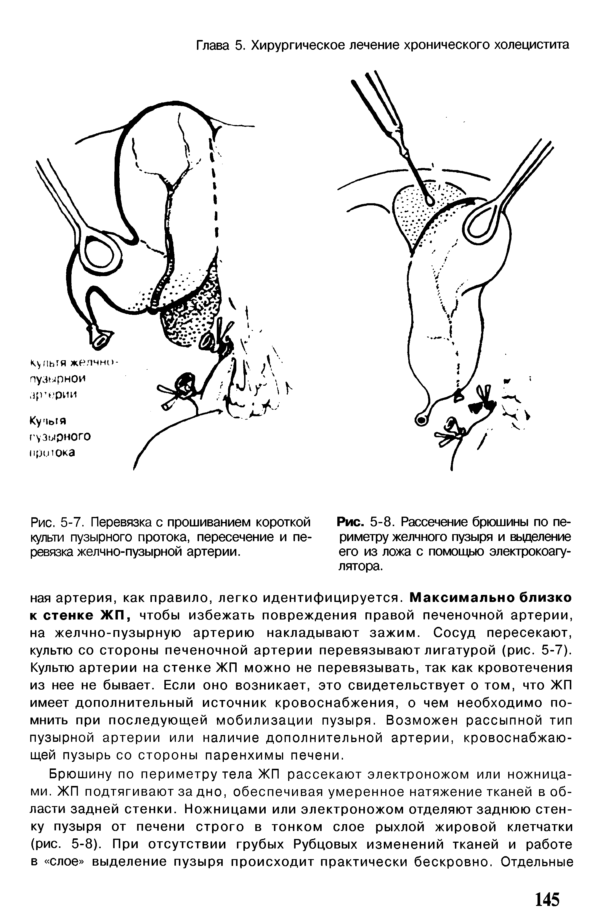 Рис. 5-7. Перевязка с прошиванием короткой культи пузырного протока, пересечение и перевязка желчно-пузырной артерии.