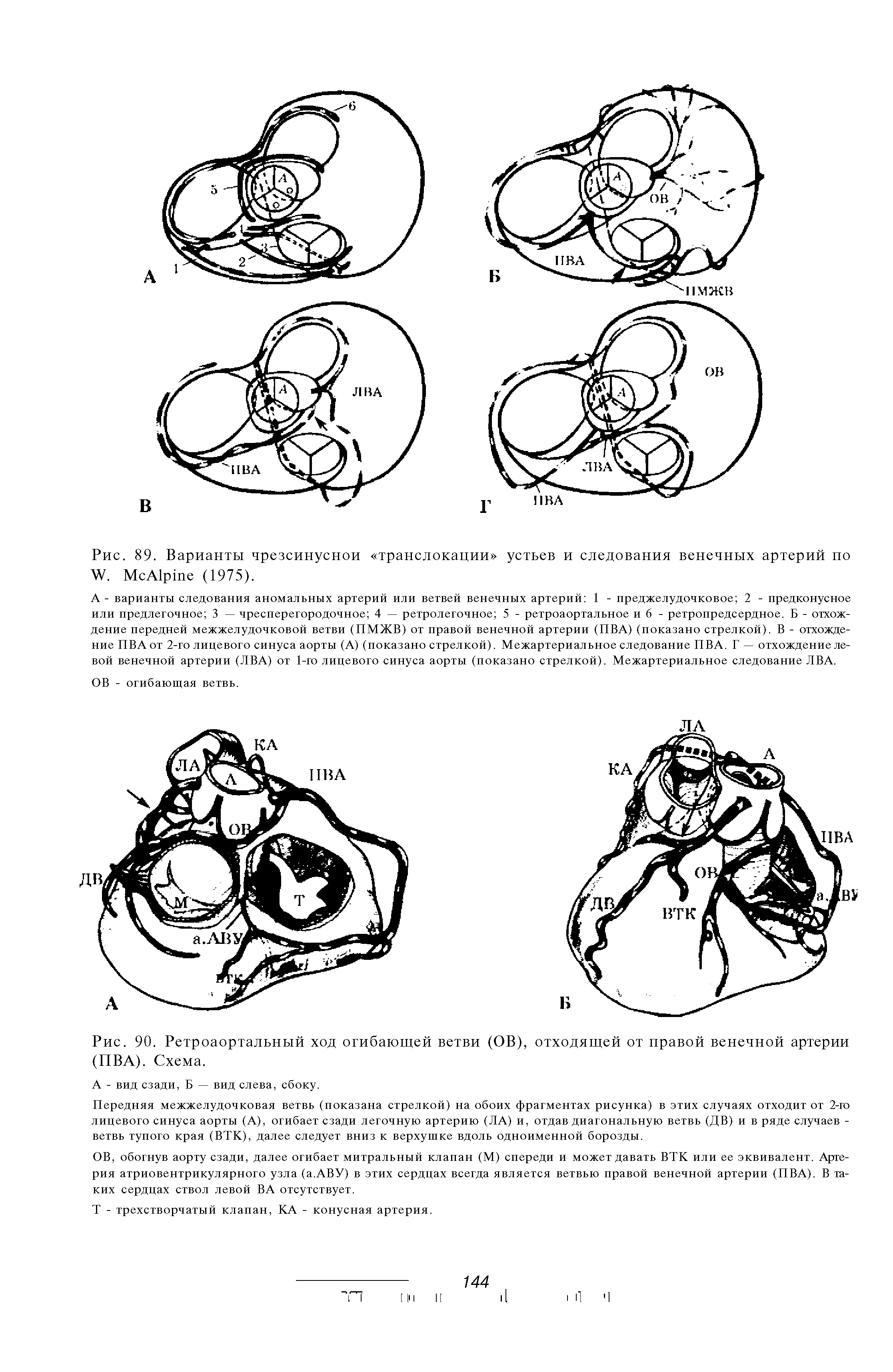 Рис. 89. Варианты чрезсинуснои транслокации устьев и следования венечных артерий по W. M A (1975).