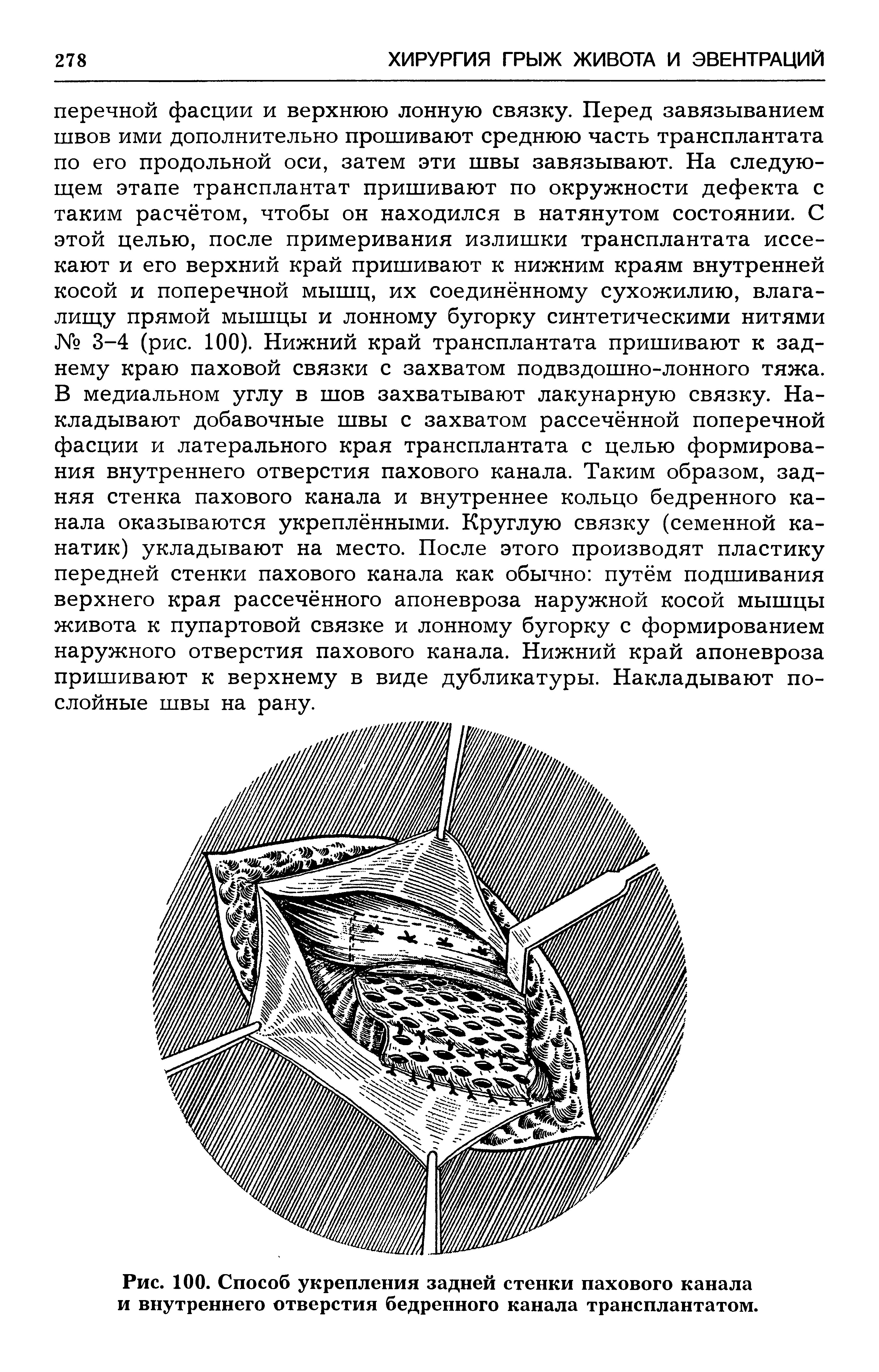 Рис. 100. Способ укрепления задней стенки пахового канала и внутреннего отверстия бедренного канала трансплантатом.