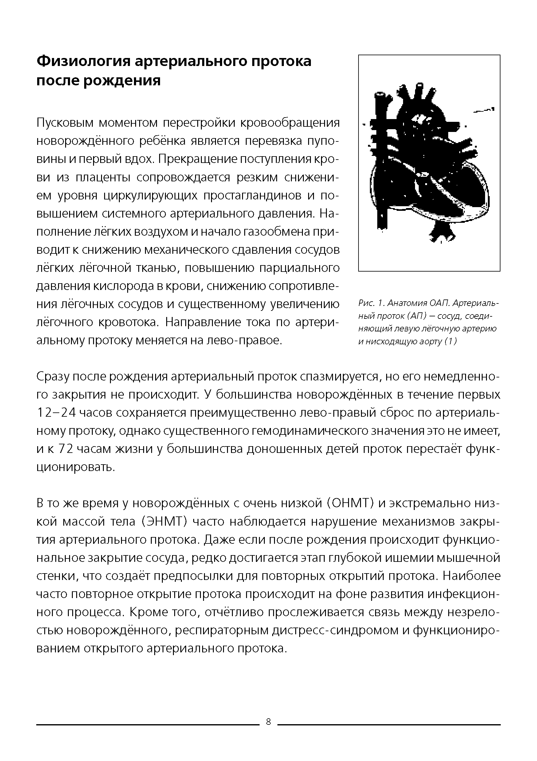 Рис. 1. Анатомия ОАП. Артериальный проток (АП) — сосуд, соединяющий левую лёгочную артерию и нисходящую аорту (1)...