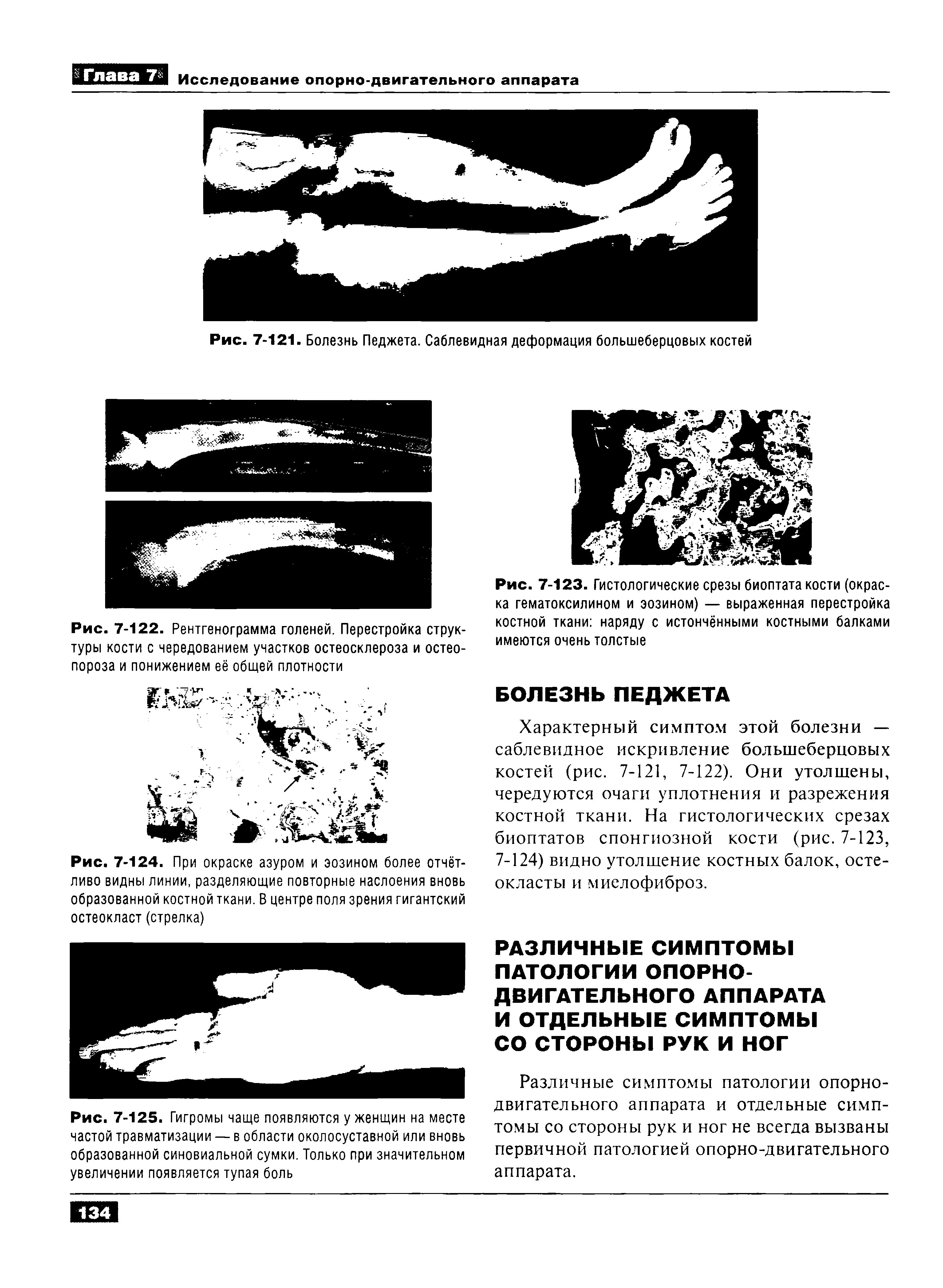 Рис. 7-123. Гистологические срезы биоптата кости (окраска гематоксилином и эозином) — выраженная перестройка костной ткани наряду с истончёнными костными балками имеются очень толстые...