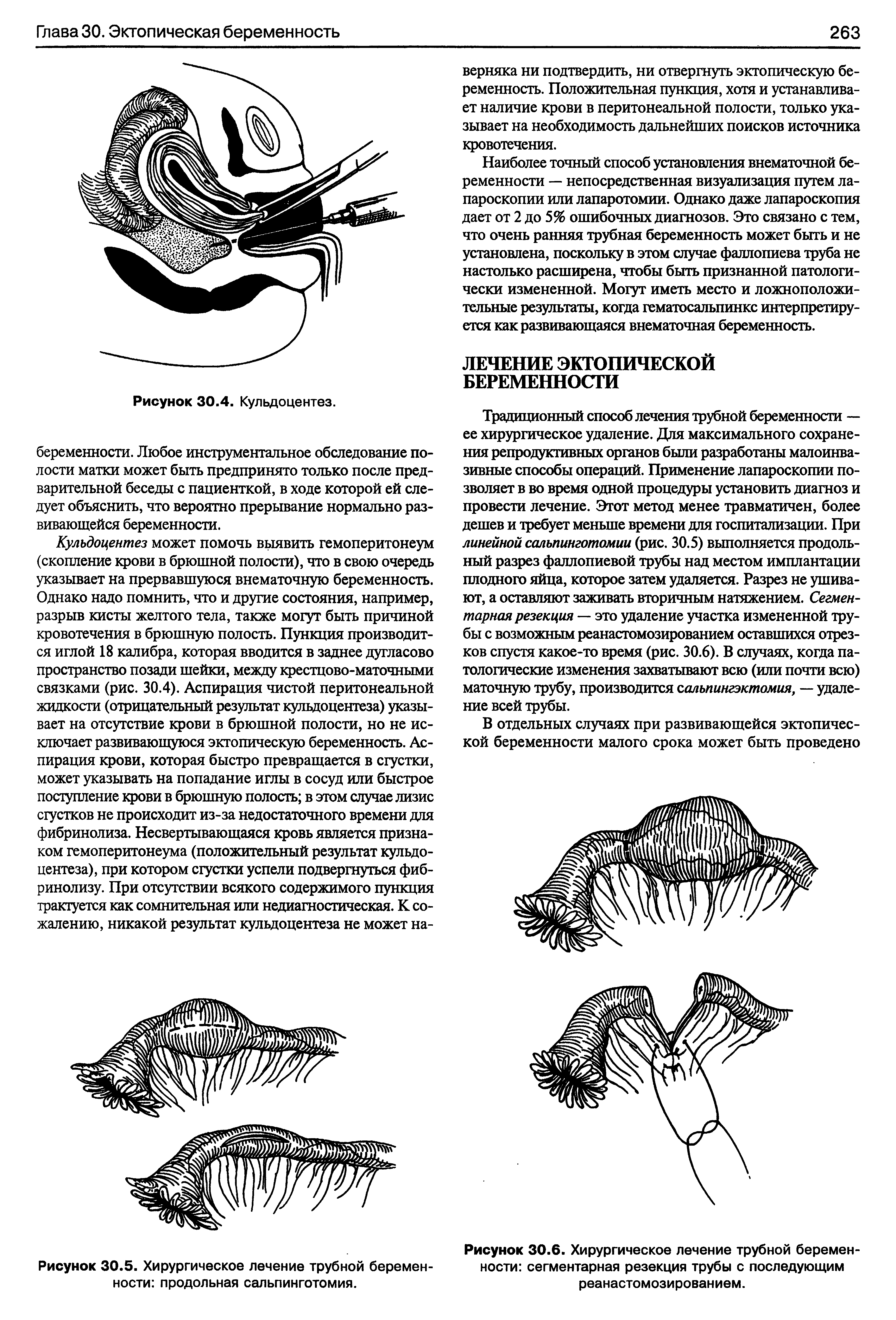 Рисунок 30.6. Хирургическое лечение трубной беремен ности сегментарная резекция трубы с последующим реанастомозированием.