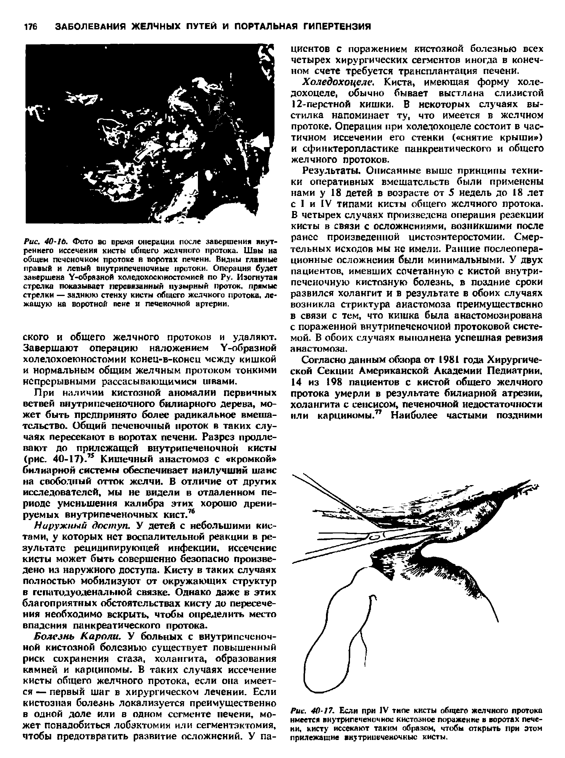 Рис. 40-17. Если при IV типе кисты общего желчного протока имеется внутрипеченочиос кистозное поражение в воротах печени, кисту иссекают таким образом, чтобы открыть при этом прилежащие внутрипеченочкыс кисты.