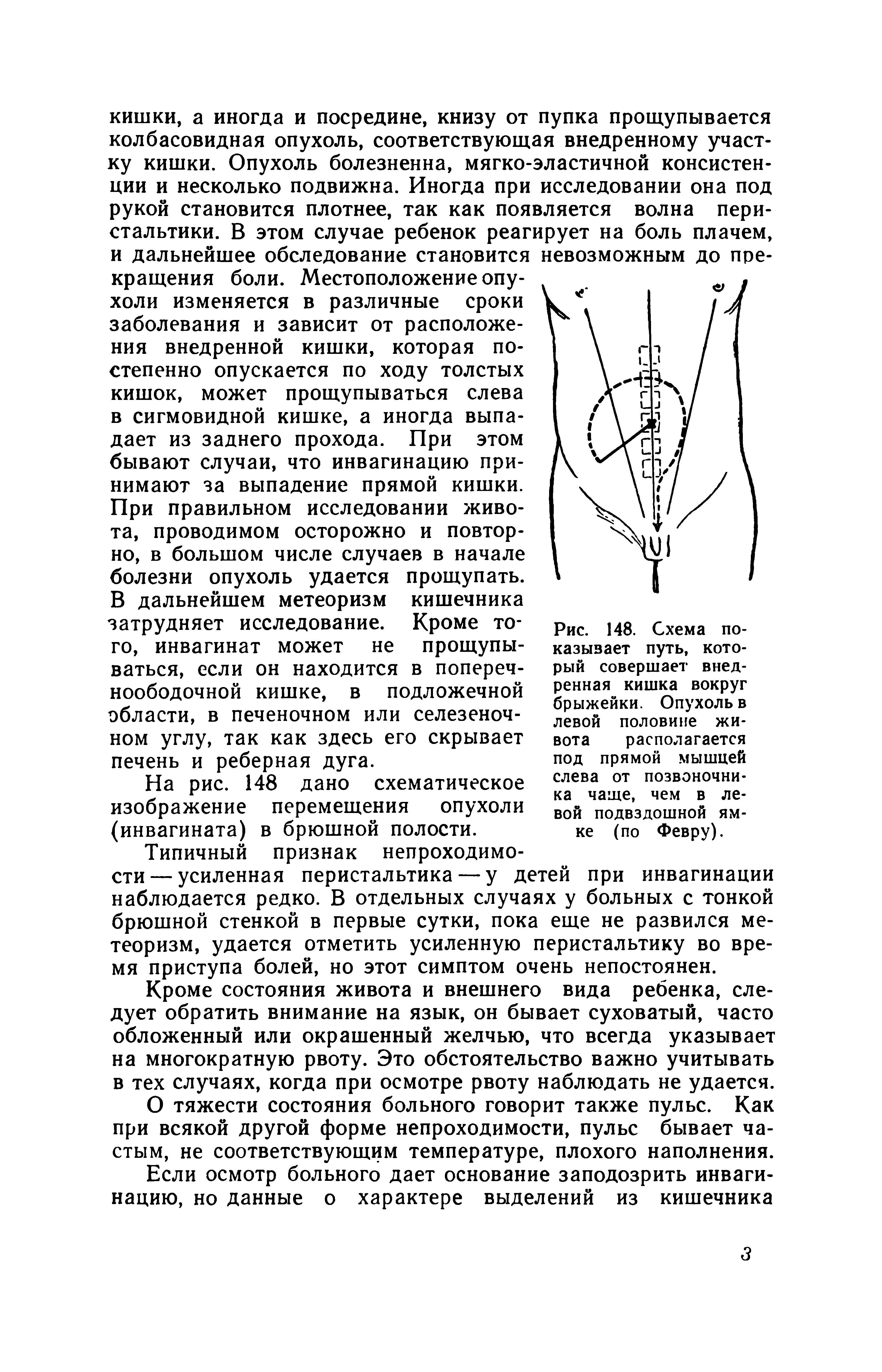 Рис. 148. Схема показывает путь, который совершает внедренная кишка вокруг брыжейки. Опухоль в левой половине живота располагается под прямой мышцей слева от позвоночника чаще, чем в левой подвздошной ямке (по Февру).