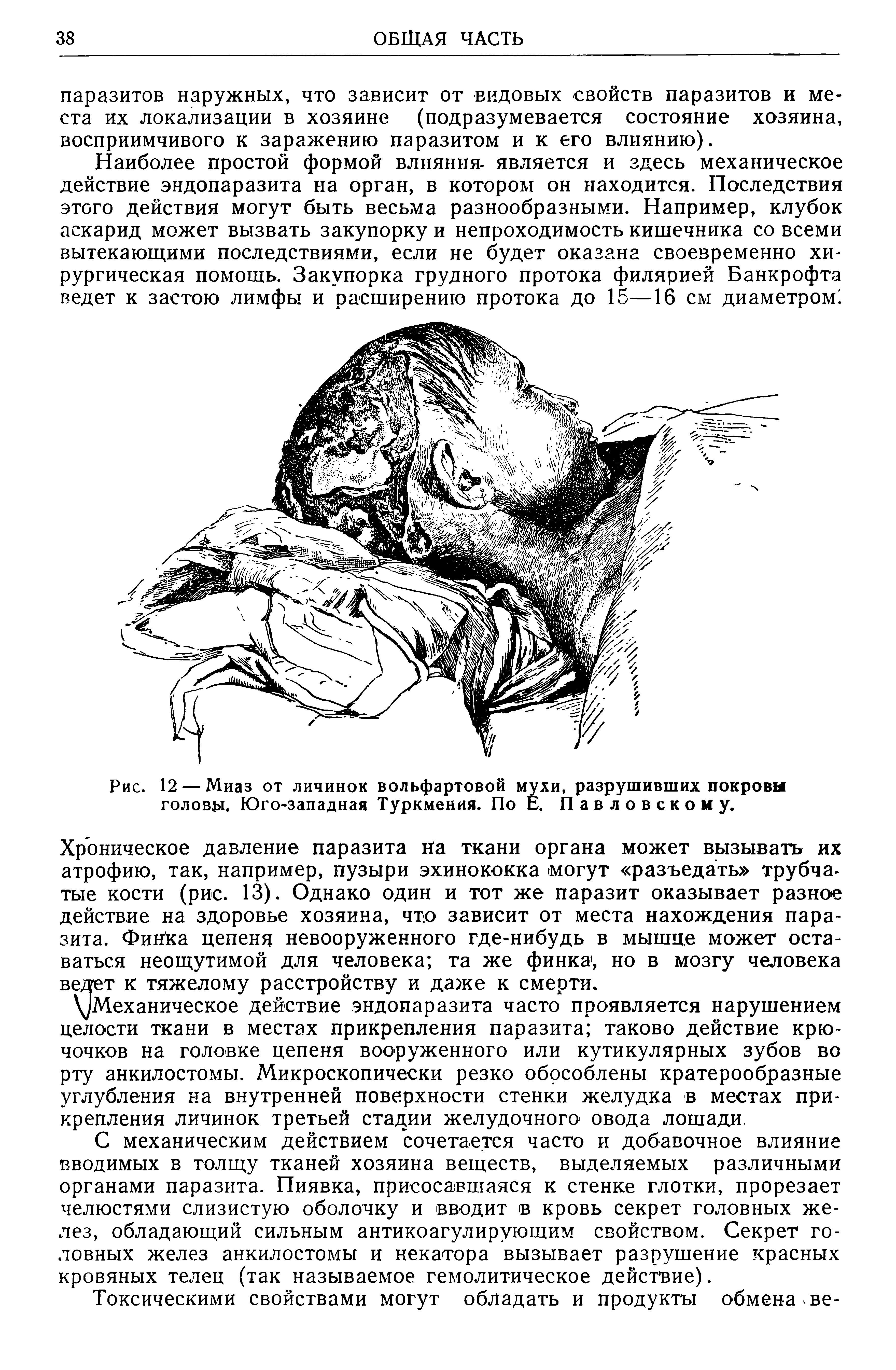 Рис. 12 — Миаз от личинок вольфартовой мухи, разрушивших покровы голову. Юго-западная Туркмения. По Е. Павловскому.