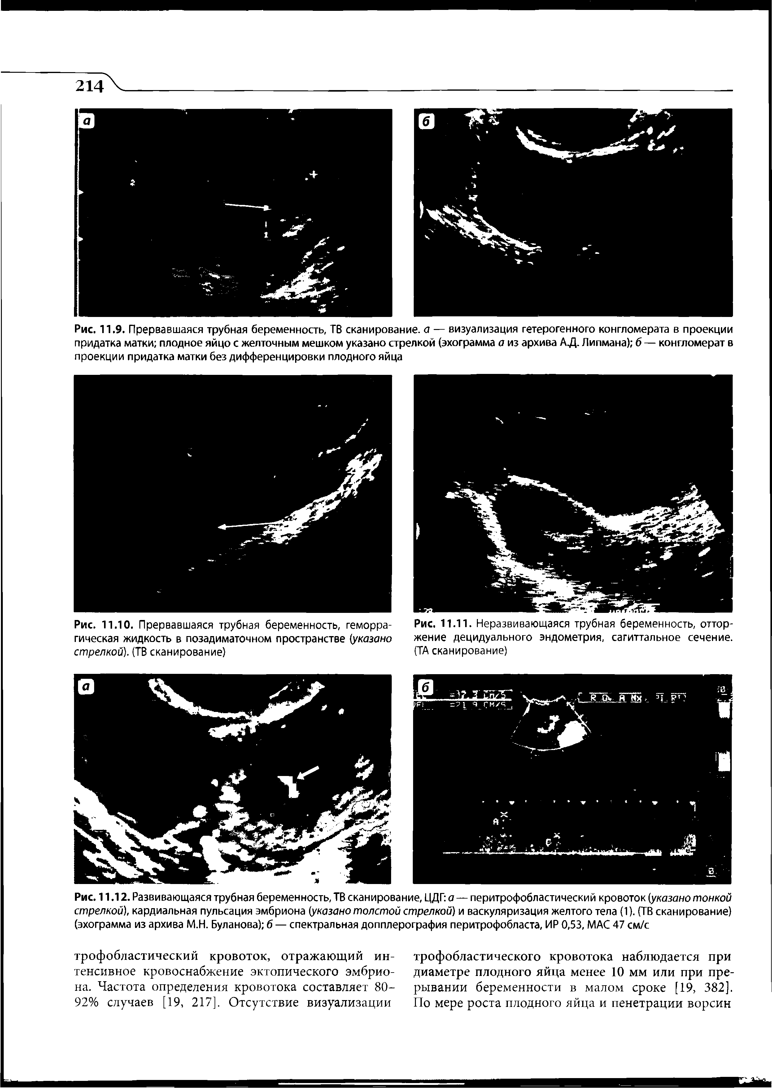 Рис. 11.12. Развивающаяся трубная беременность, ТВ сканирование, ЦДГ а — перитрофобластический кровоток (указано тонкой стрелкой), кардиальная пульсация эмбриона (указано толстой стрелкой) и васкуляризация желтого тела (1). (ТВ сканирование) (эхограмма из архива М.Н. Буланова) 6 — спектральная допплерография перитрофобласта, ИР 0,53, МАС 47 см/с...