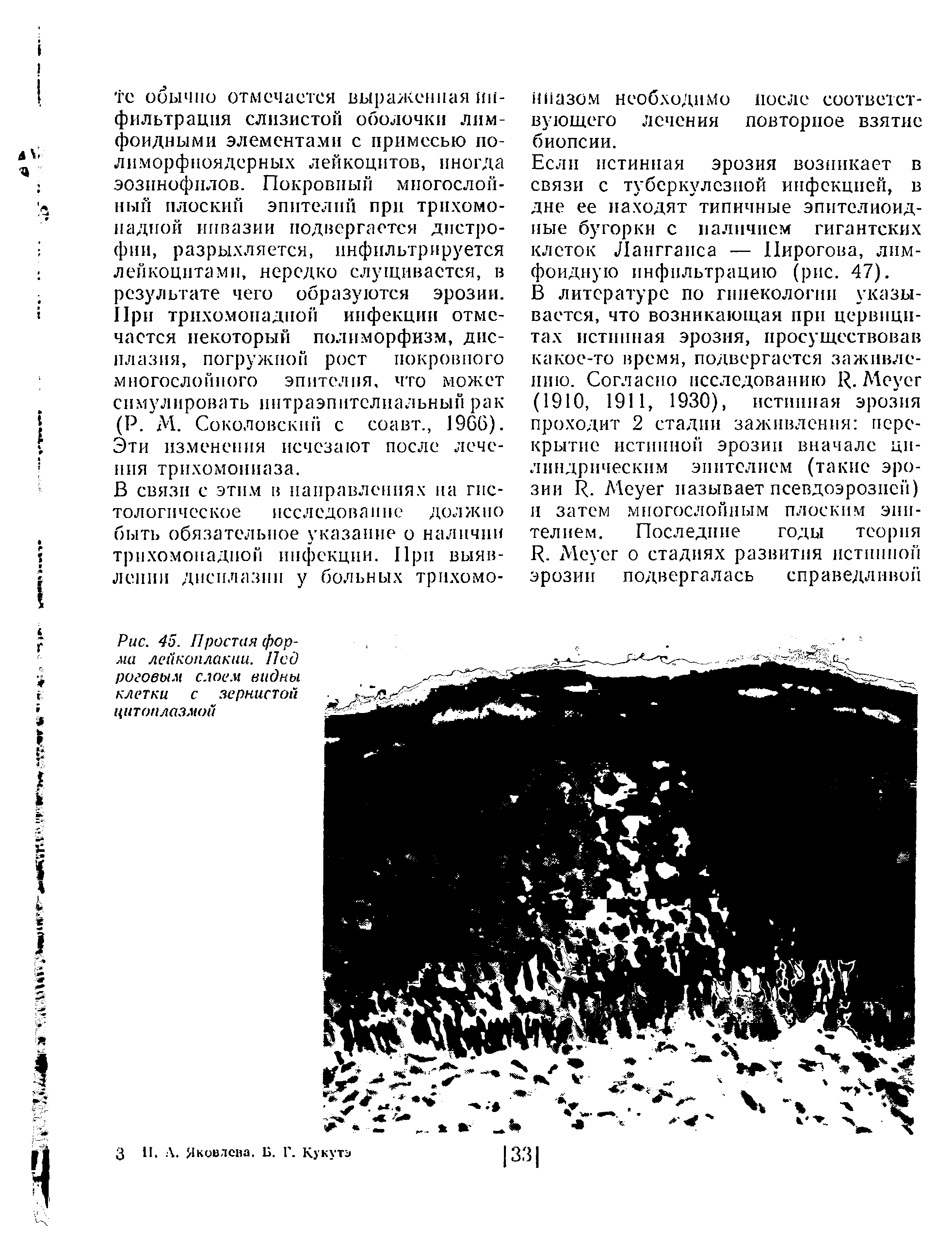 Рис. 45. Простая форма лейкоплакии. Под роговым слоем видны клетки с зернистой цитоплазмой...