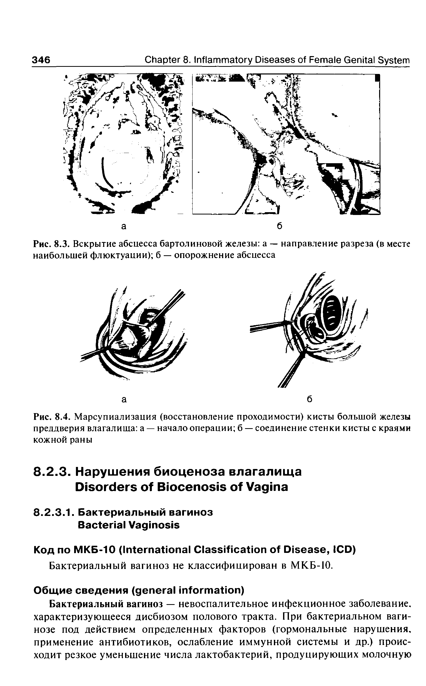 Рис. 8.4. Марсупиализация (восстановление проходимости) кисты большой железы преддверия влагалища а — начало операции б — соединение стенки кисты с краями кожной раны...