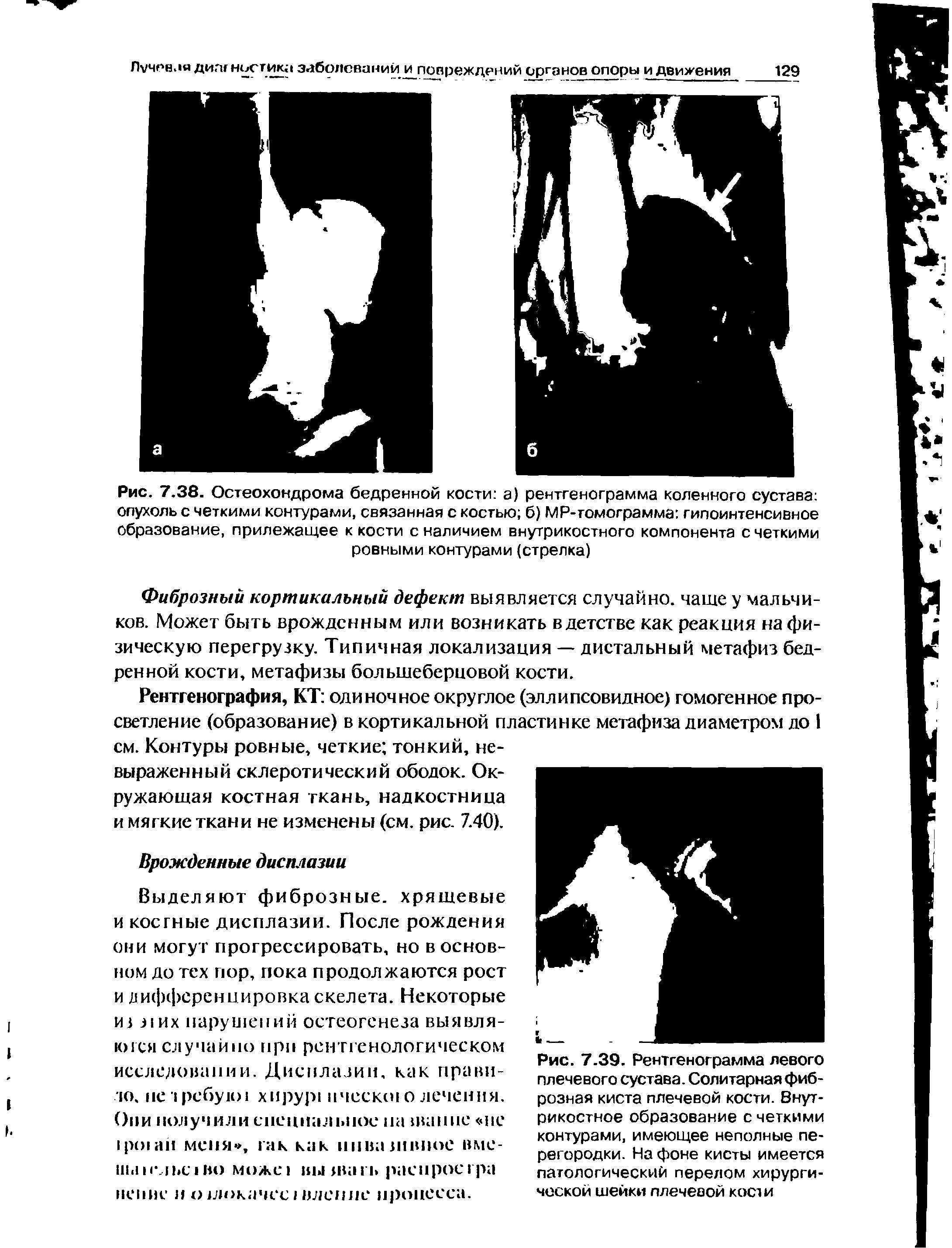 Рис. 7.38. Остеохондрома бедренной кости а) рентгенограмма коленного сустава опухоль с четкими контурами, связанная с костью б) МР-томограмма гипоинтенсивное образование, прилежащее к кости с наличием внутрикостного компонента с четкими ровными контурами (стрелка)...