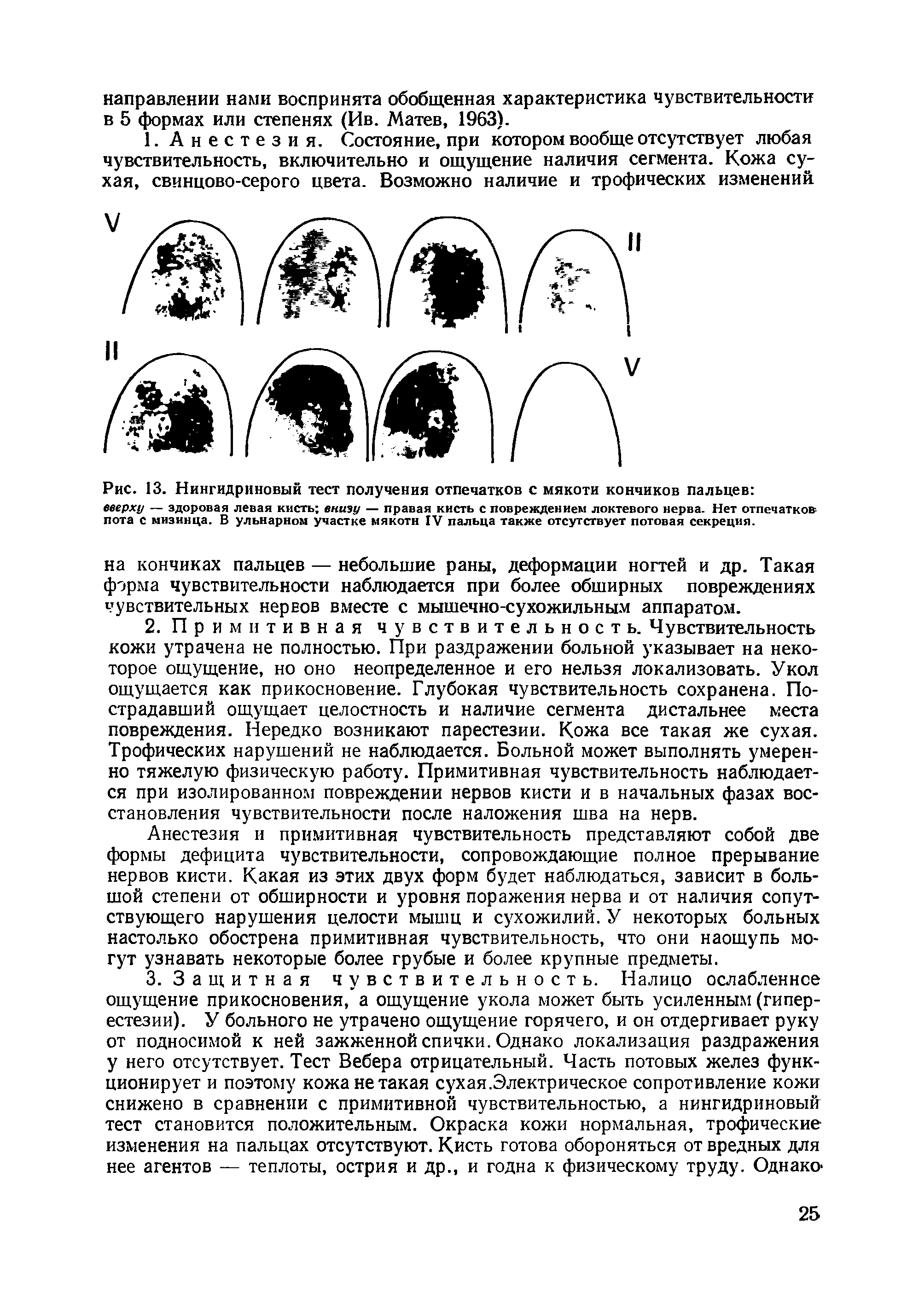 Рис. 13. Нингидриновый тест получения отпечатков с мякоти кончиков пальцев вверху — здоровая левая кисть внизу — правая кисть с повреждением локтевого нерва. Нет отпечатков пота с мизинца. В ульнарном участке мякотн IV пальца также отсутствует потовая секреция.