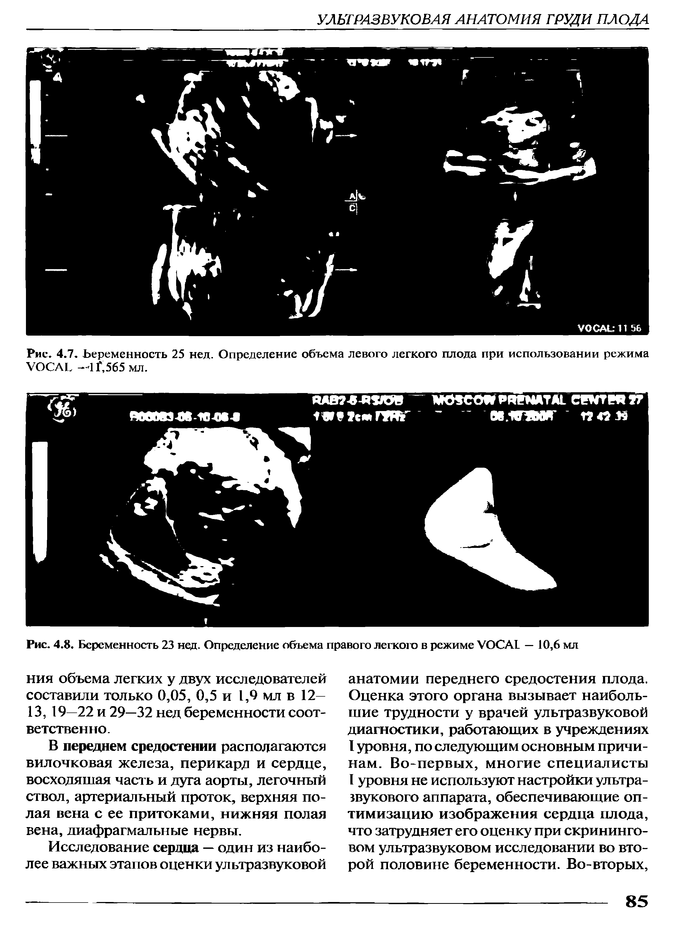 Рис. 4.7. Беременность 25 нед. Определение объема левого легкого плода при использовании режима VOCAL -4 Г,565 мл.