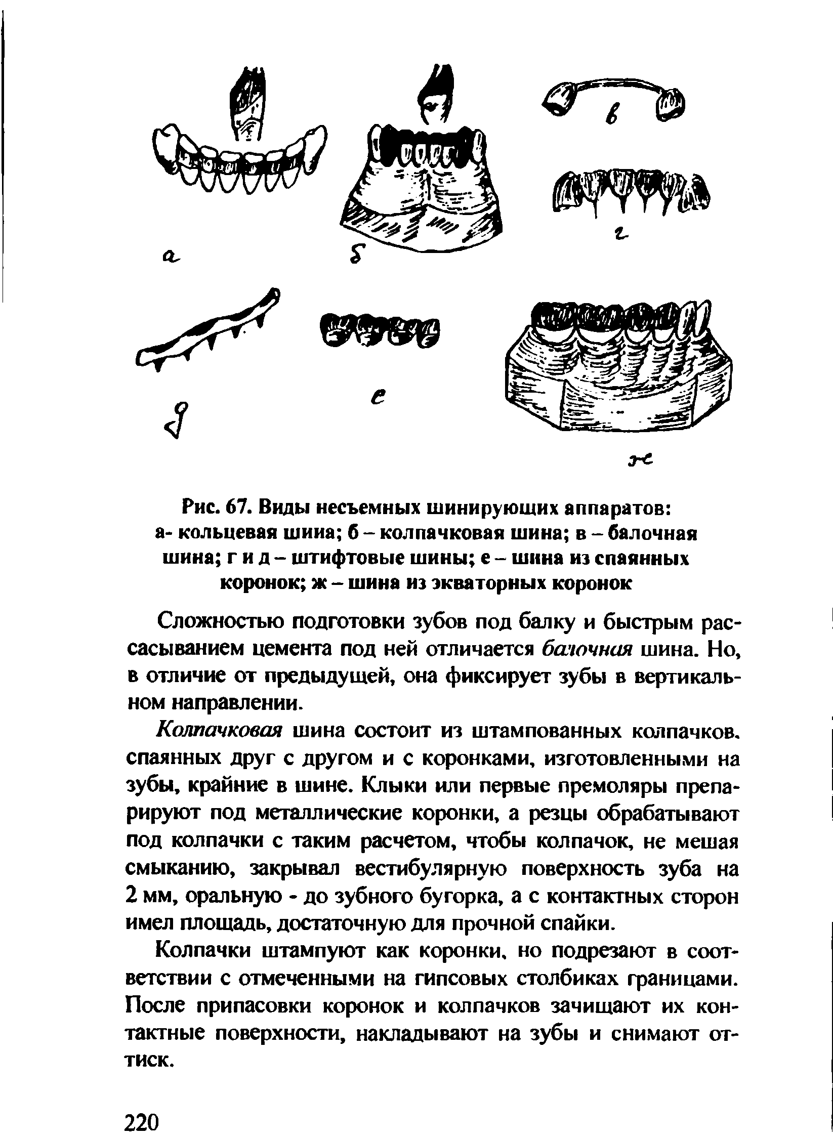 Рис. 67. Виды несъемных шинирующих аппаратов а- кольцевая шина б - колпачковая шина в - балочная шина гид- штифтовые шины е - шина из спаянных коронок ж - шина из экваторных коронок...