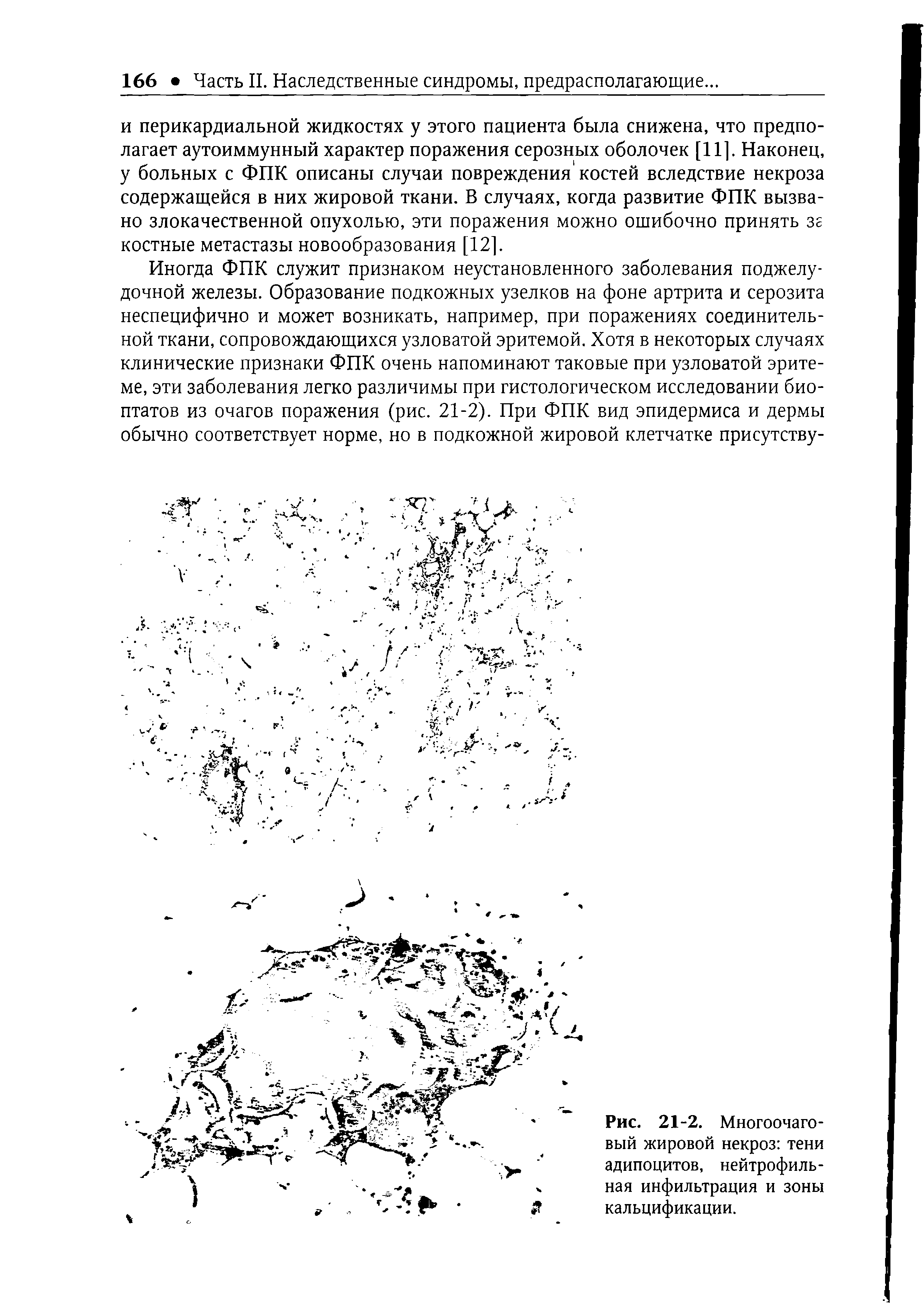 Рис. 21-2. Многоочаговый жировой некроз тени адипоцитов, нейтрофильная инфильтрация и зоны кальцификации.