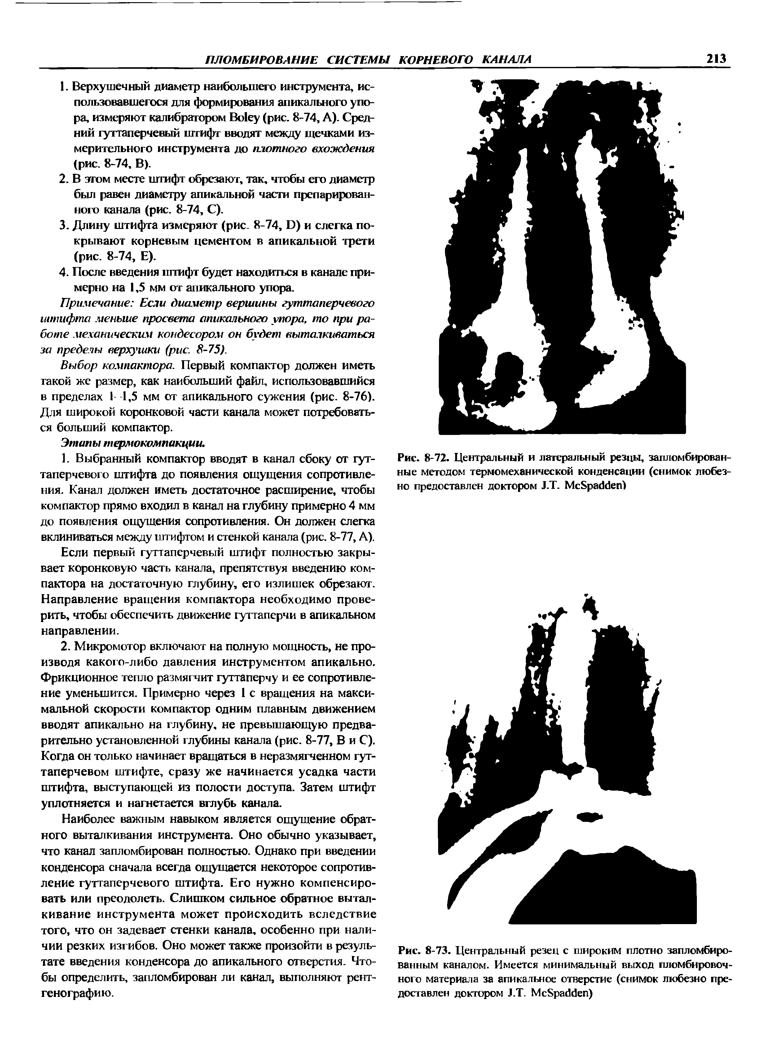 Рис. 8-72. Центральный и латеральный резцы, запломбированные методом термомеханической конденсации (снимок любезно предоставлен доктором Л.Т. Мс8ра<1<1еп)...