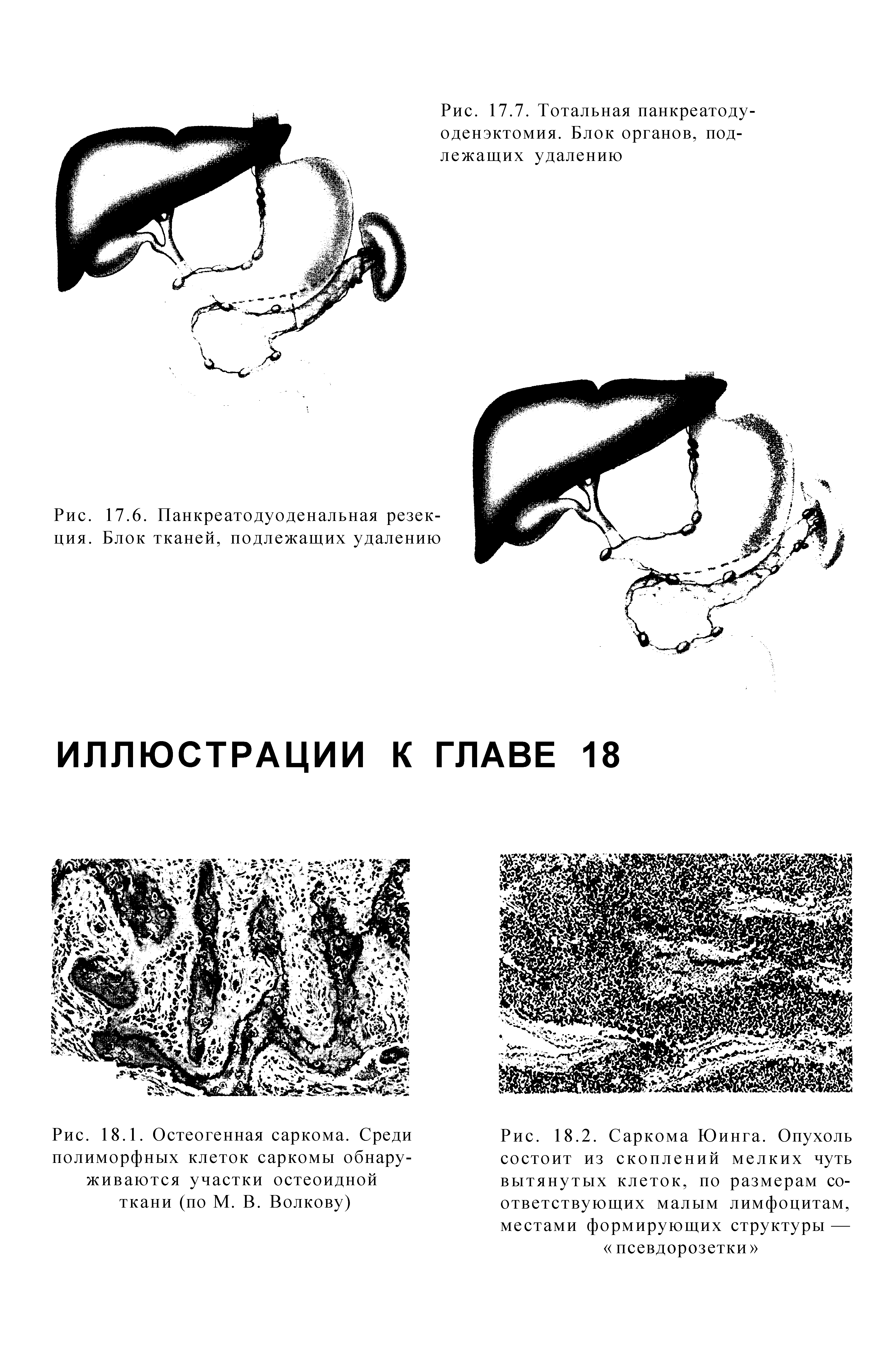 Рис. 18.2. Саркома Юинга. Опухоль состоит из скоплений мелких чуть вытянутых клеток, по размерам соответствующих малым лимфоцитам, местами формирующих структуры — псевдорозетки ...