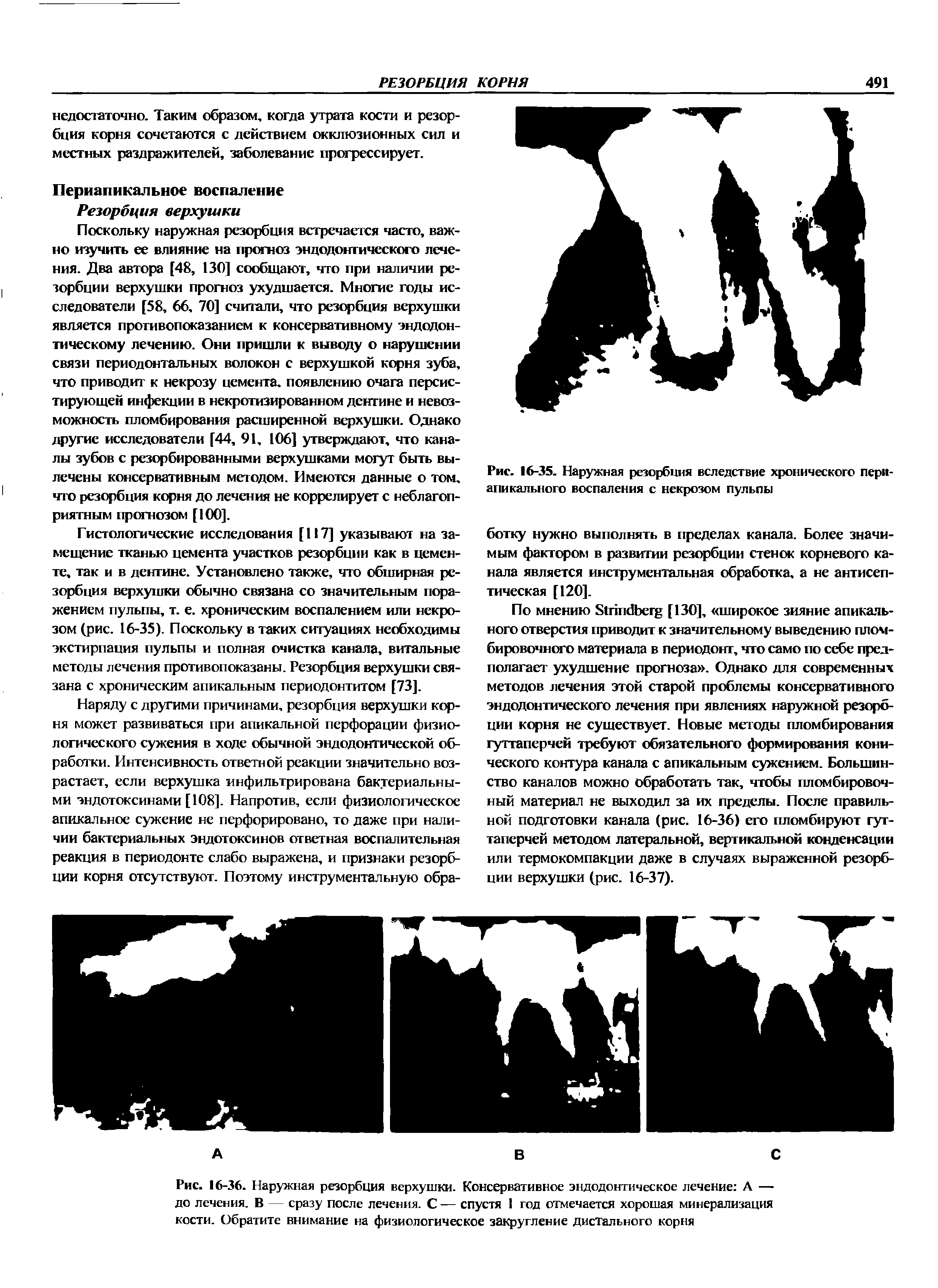 Рис. 16-36. Наружная резорбция верхушки. Консервативное эндодонтическое лечение А — до лечения. В — сразу после лечения. С — спустя 1 год отмечается хорошая минерализация кости. Обратите внимание на физиологическое закругление дистального корня...