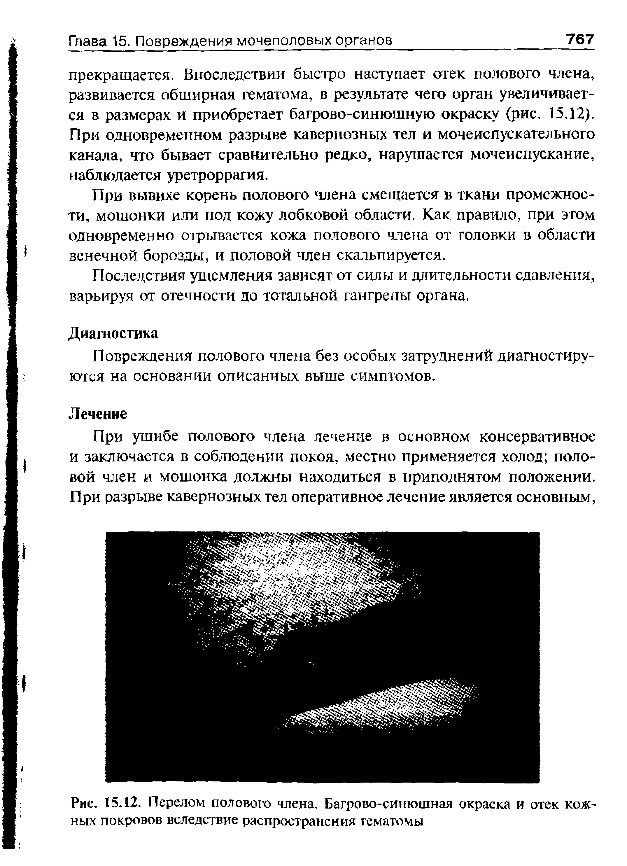 Рис. 15.12. Перелом полового члена. Багрово-синюшная окраска и отек кожных покровов вследствие распространения гематомы...