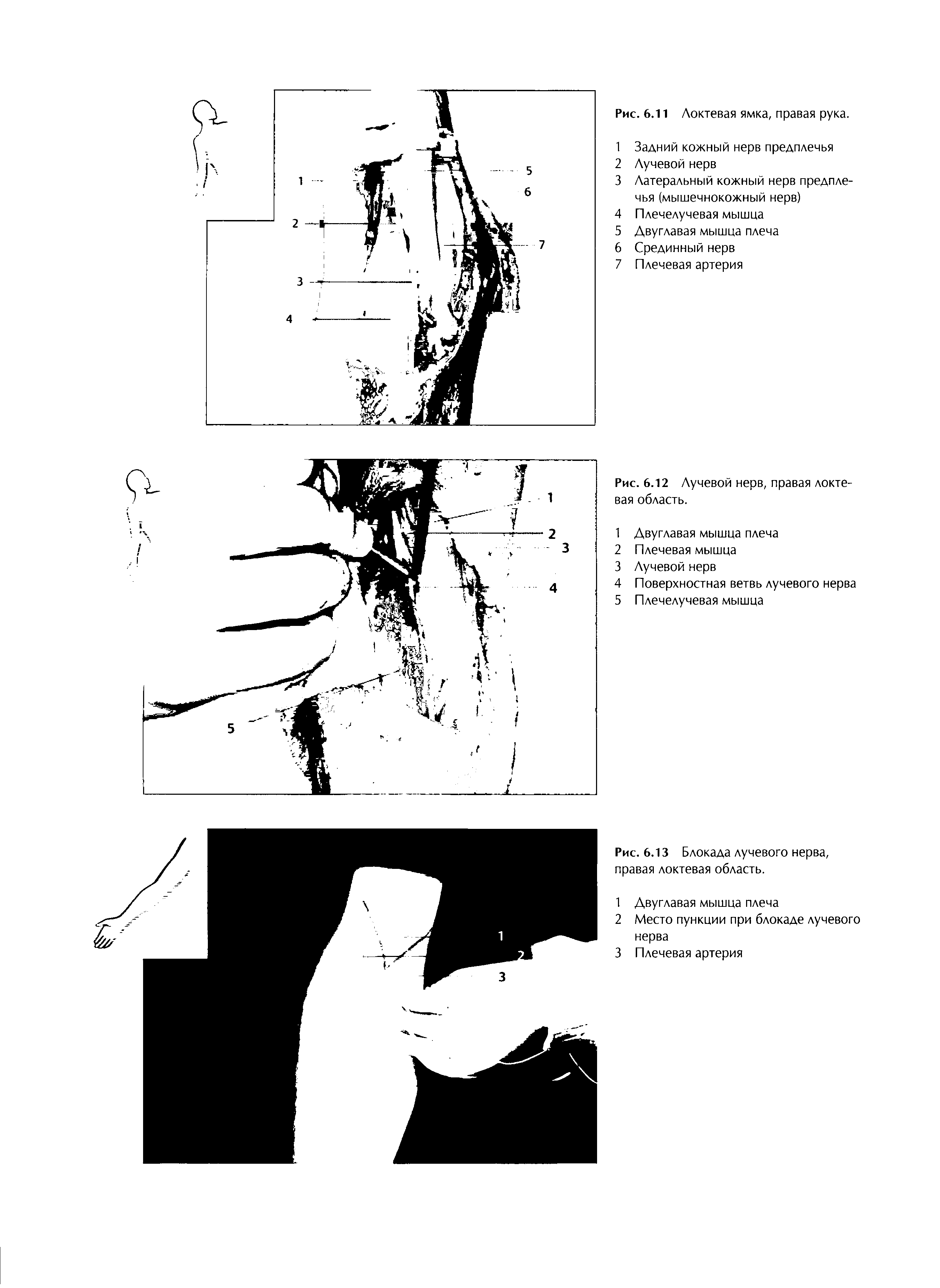 Рис. 6.13 Блокада лучевого нерва, правая локтевая область.