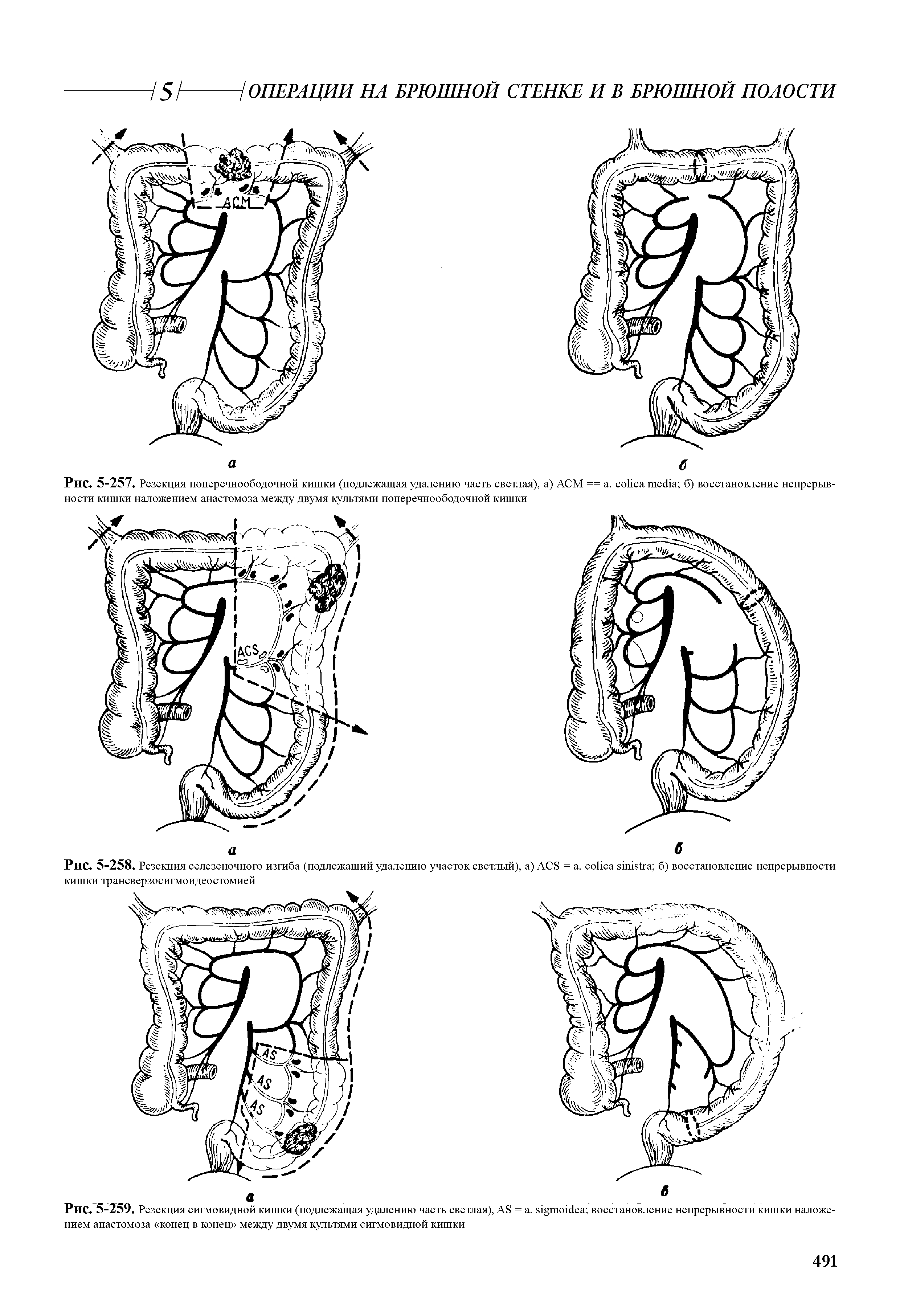 Рис. 5-257. Резекция поперечноободочной кишки (подлежащая удалению часть светлая), а) АСМ == . б) восстановление непрерывности кишки наложением анастомоза между двумя культями поперечноободочной кишки...