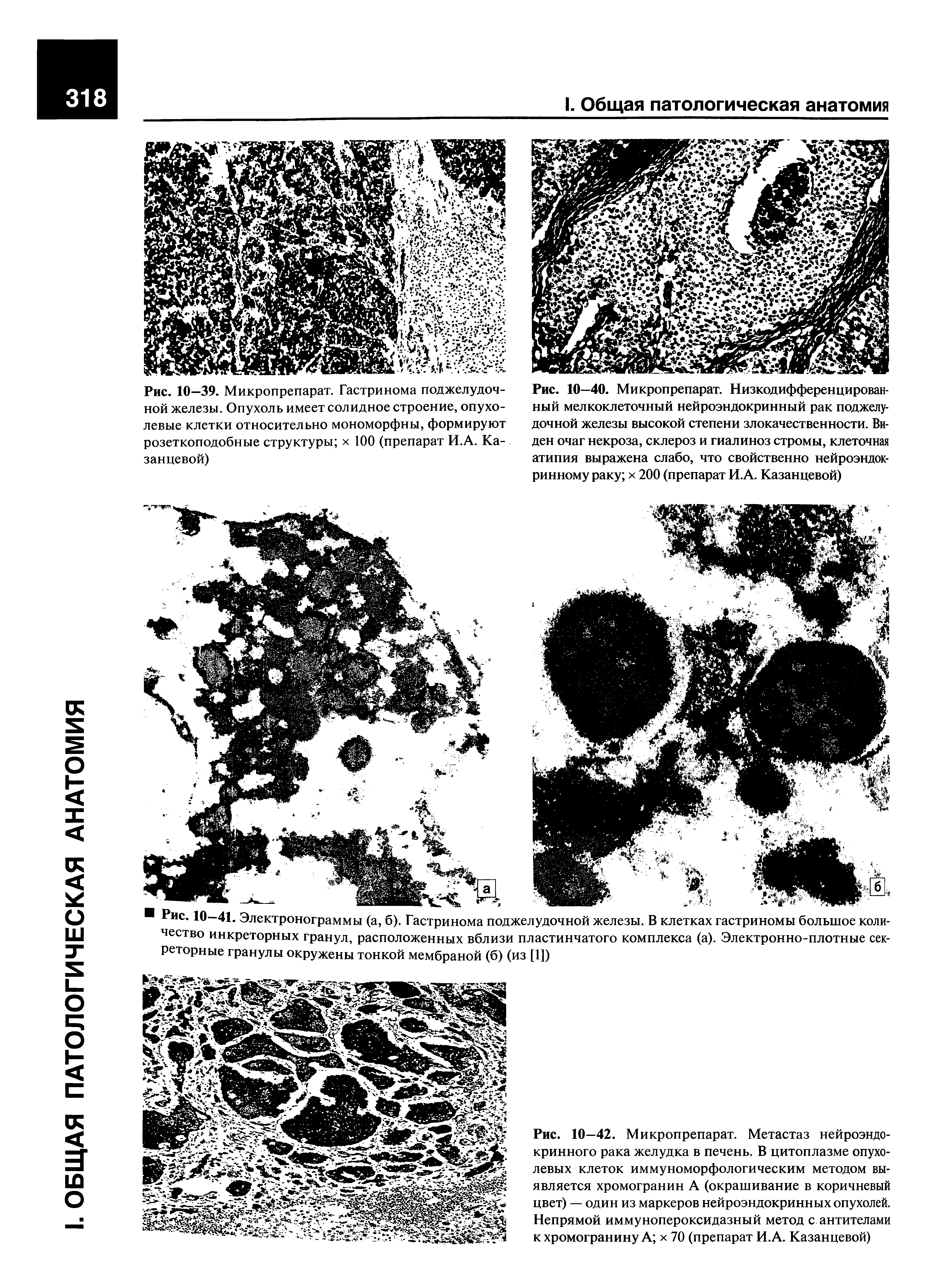 Рис. 10—39. Микропрепарат. Гастринома поджелудочной железы. Опухоль имеет солидное строение, опухолевые клетки относительно мономорфны, формируют розеткоподобные структуры х 100 (препарат И.А. Казанцевой)...