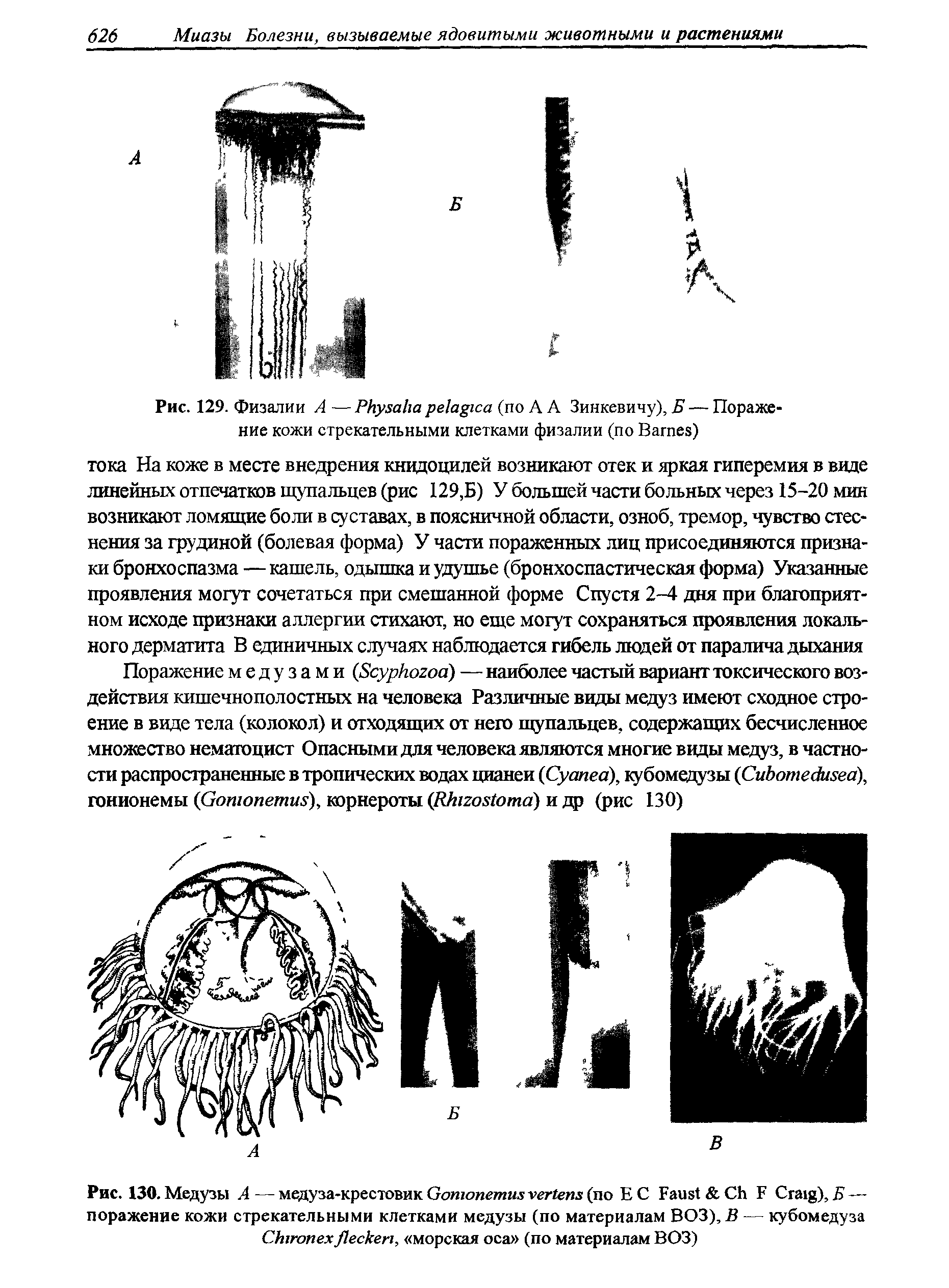 Рис. 130. Медузы А — медуза-крестовик G (по ЕС F C F C ), Б — поражение кожи стрекательными клетками медузы (по материалам ВОЗ), В — кубомедуза C , морская оса (по материалам ВОЗ)...