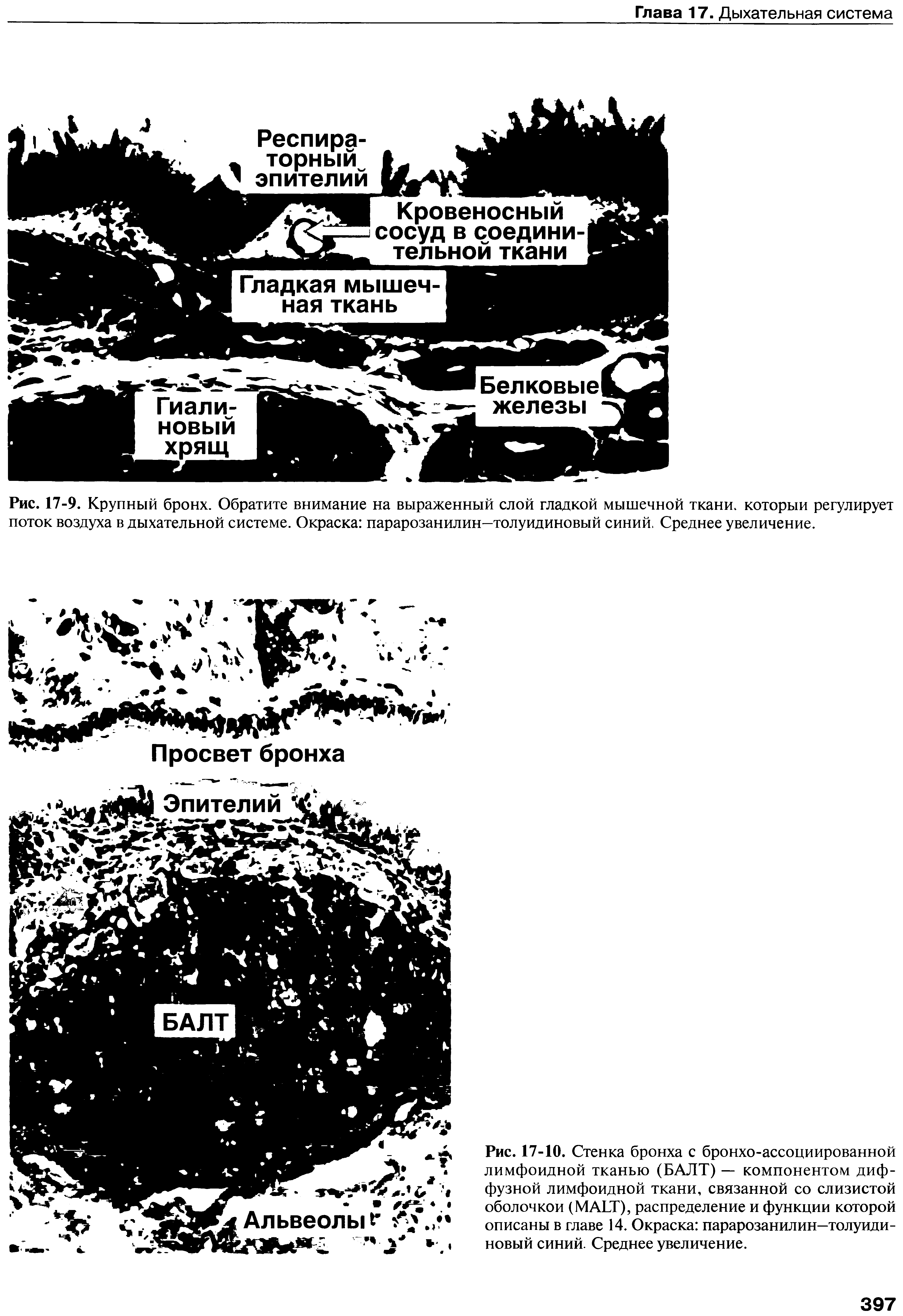 Рис. 17-10. Стенка бронха с бронхо-ассоциированной лимфоидной тканью (БАЛТ) — компонентом диффузной лимфоидной ткани, связанной со слизистой оболочкой (MALT), распределение и функции которой описаны в главе 14. Окраска парарозанилин—толуидиновый синий. Среднее увеличение.