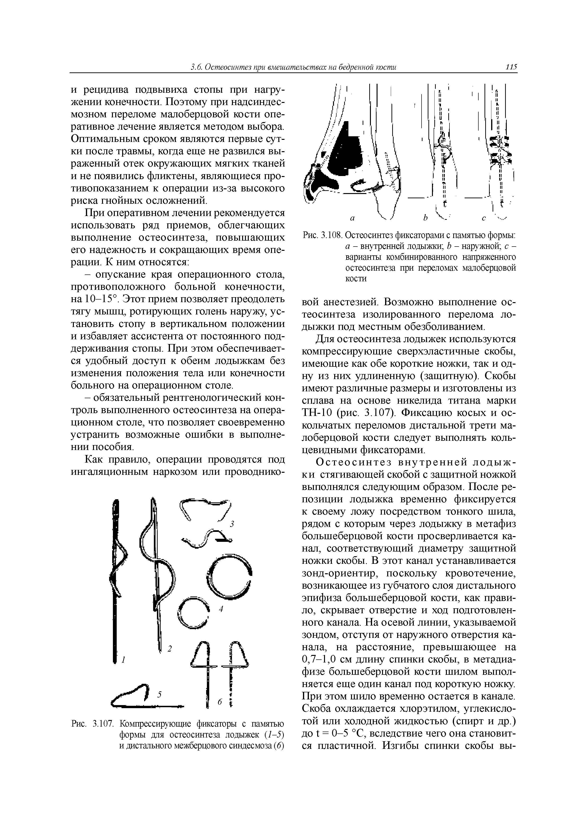 Рис. 3.107. Компрессирующие фиксаторы с памятью формы для остеосинтеза лодыжек (1-5) и дистального межберцового синдесмоза (б)...