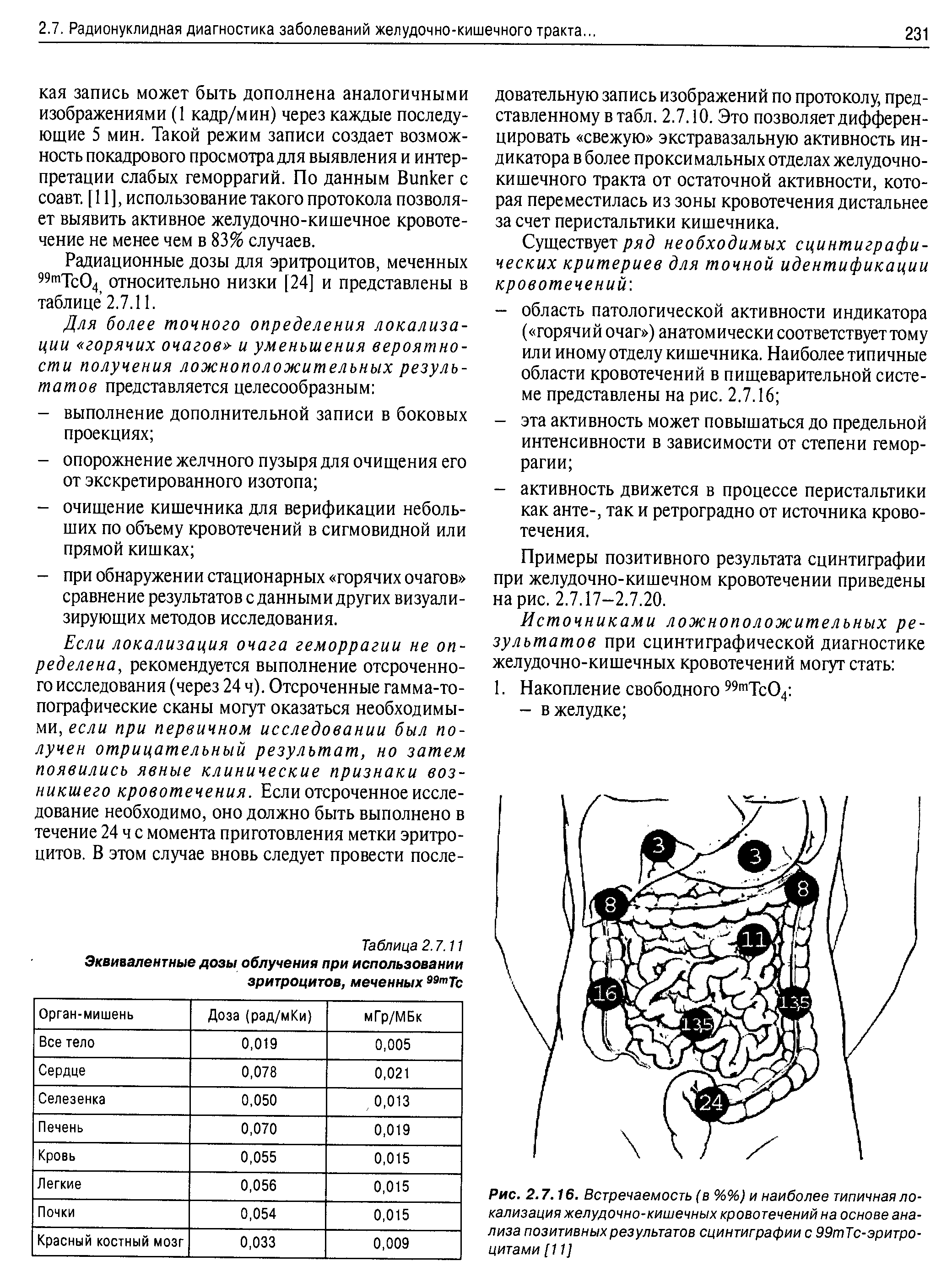 Рис. 2.7.16. Встречаемость (в %%) и наиболее типичная локализация желудочно-кишечных кровотечений на основе анализа позитивных результатов сцинтиграфии с 99тТс-эритро-цитами [11]...