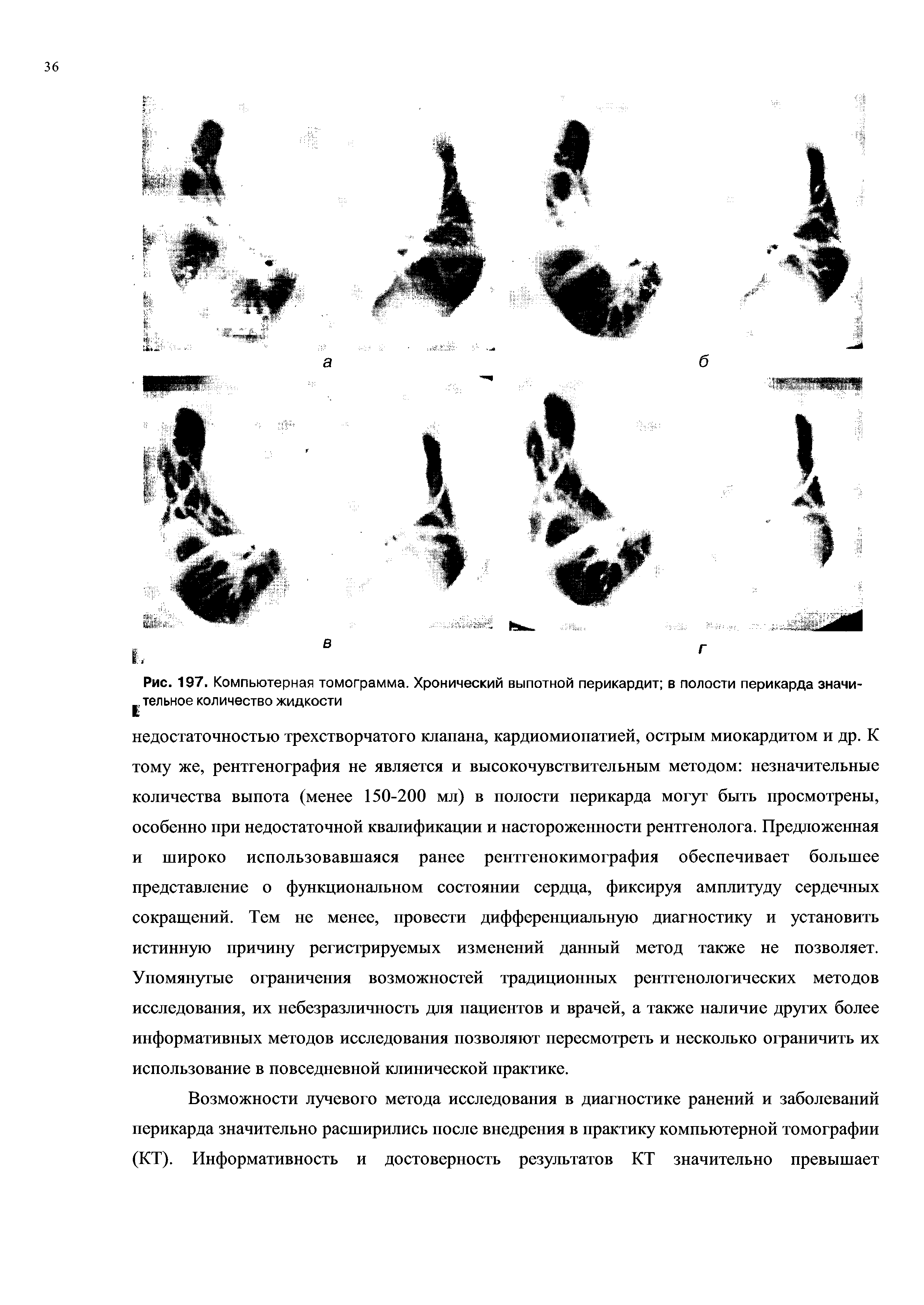 Рис. 197. Компьютерная томограмма. Хронический выпотной перикардит в полости перикарда значи-...