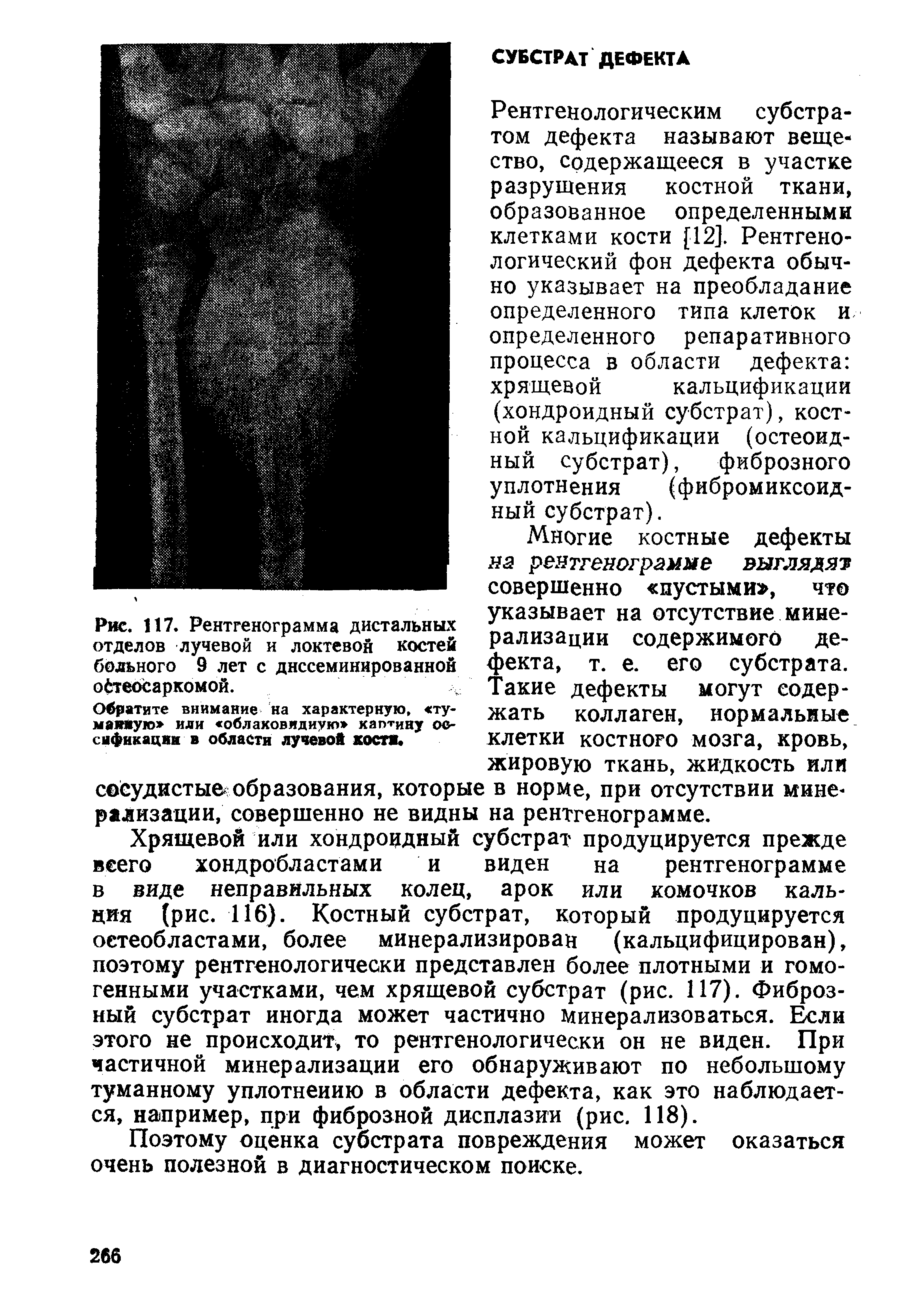 Рис. 117. Рентгенограмма дистальных отделов лучевой и локтевой костей больного 9 лет с диссеминированной остеосаркомой.