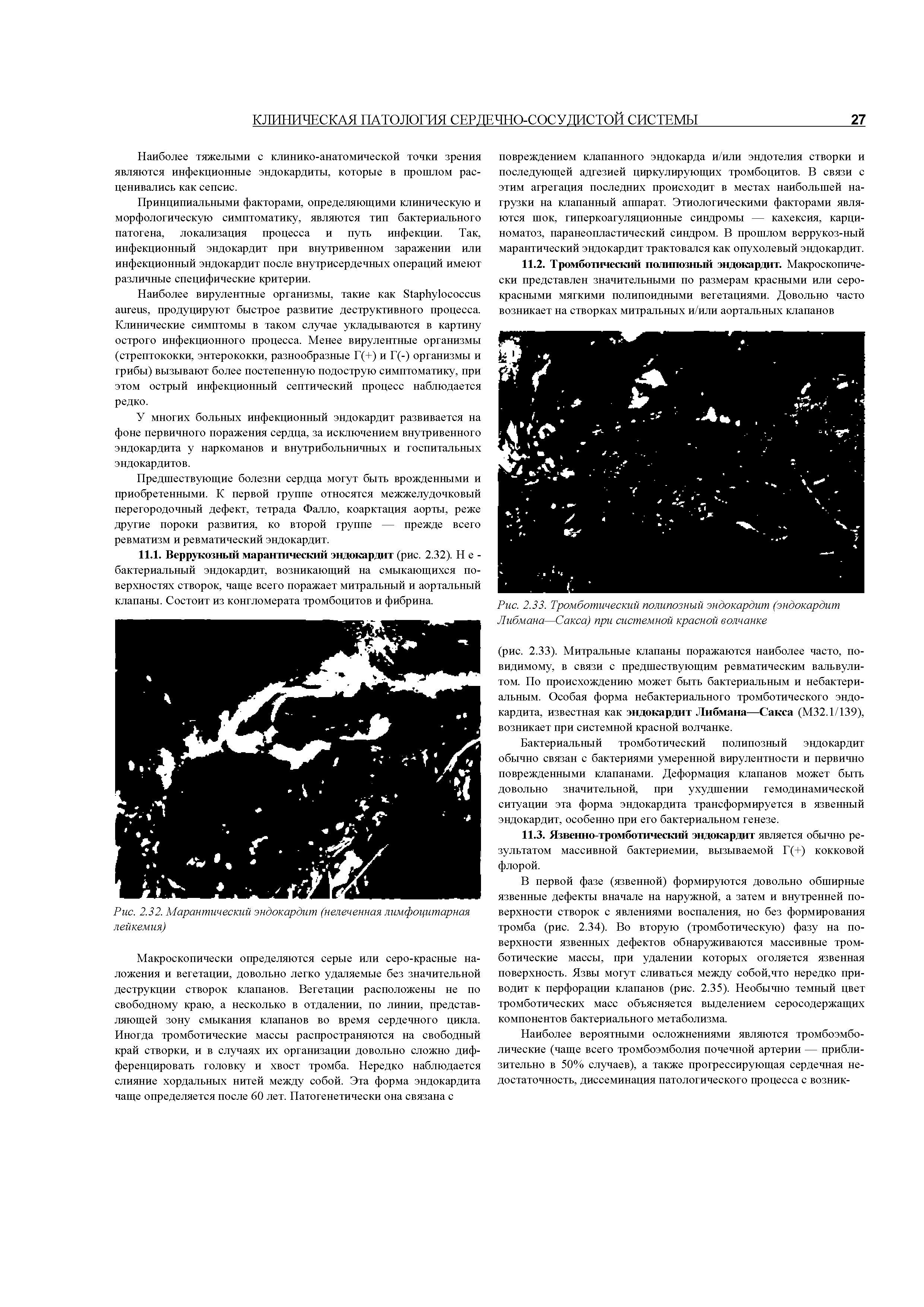 Рис. 2.33. Тромботический полипозный эндокардит (эндокардит Либмана—Сакса) при системной красной волчанке...