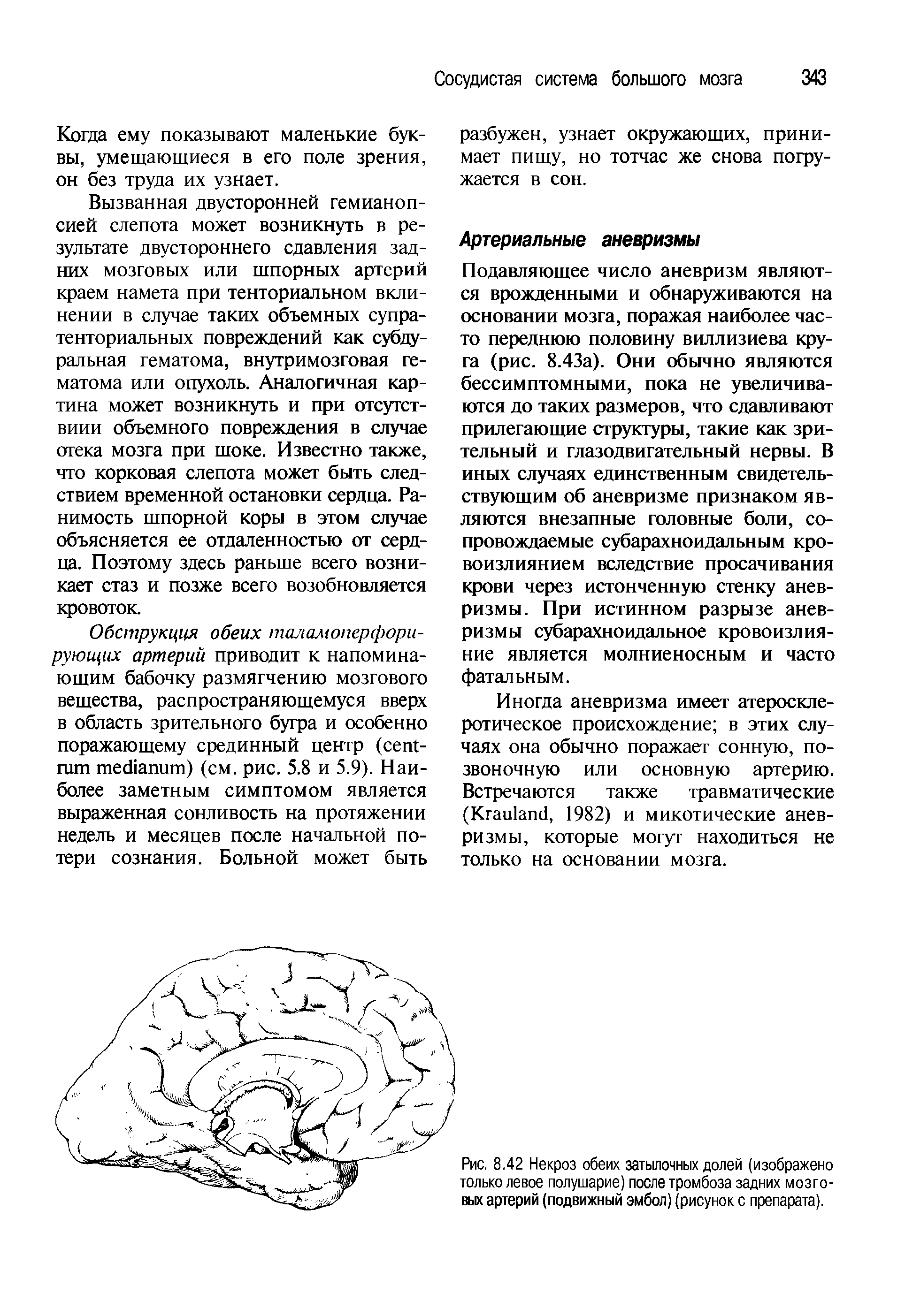 Рис. 8.42 Некроз обеих затылочных долей (изображено только левое полушарие) после тромбоза задних мозговых артерий (подвижный эмбол) (рисунок с препарата).