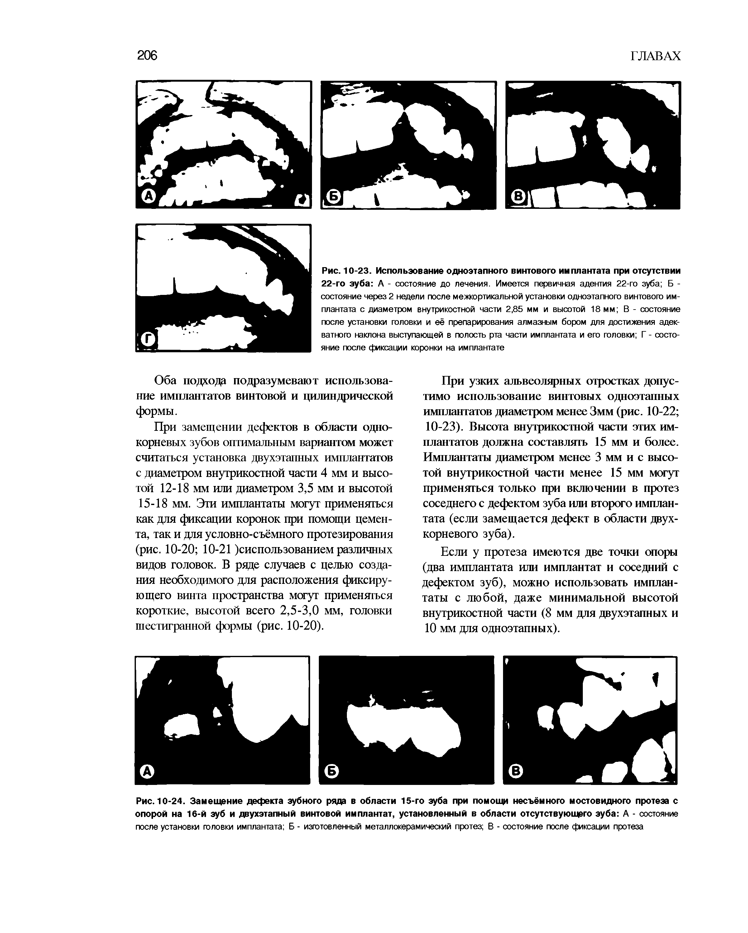 Рис. 10-24. Замещение дефекта зубного ряда в области 15-го зуба при помощи несъёмного мостовидного протеза с опорой на 16-й зуб и двухэтапный винтовой имплантат, установленный в области отсутствующего зуба А - состояние после установки головки имплантата Б - изготовленный металлокерамический протез В - состояние после фиксации протеза...