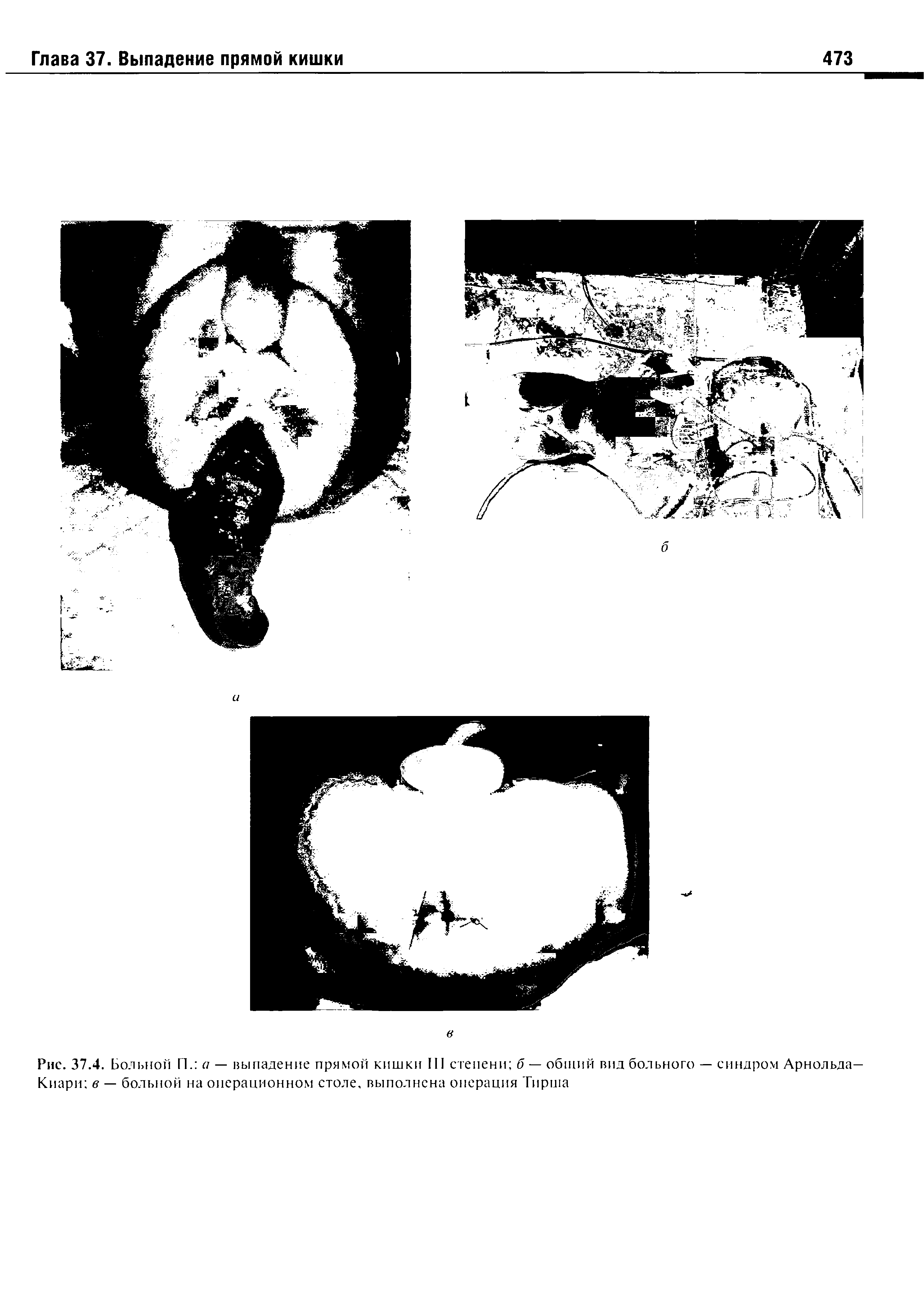 Рис. 37.4. Больной П. а — выпадение прямой кишки III степени б — общий вид больного — синдром Арнольда-Киари в — больной на операционном столе, выполнена операция Тирша...