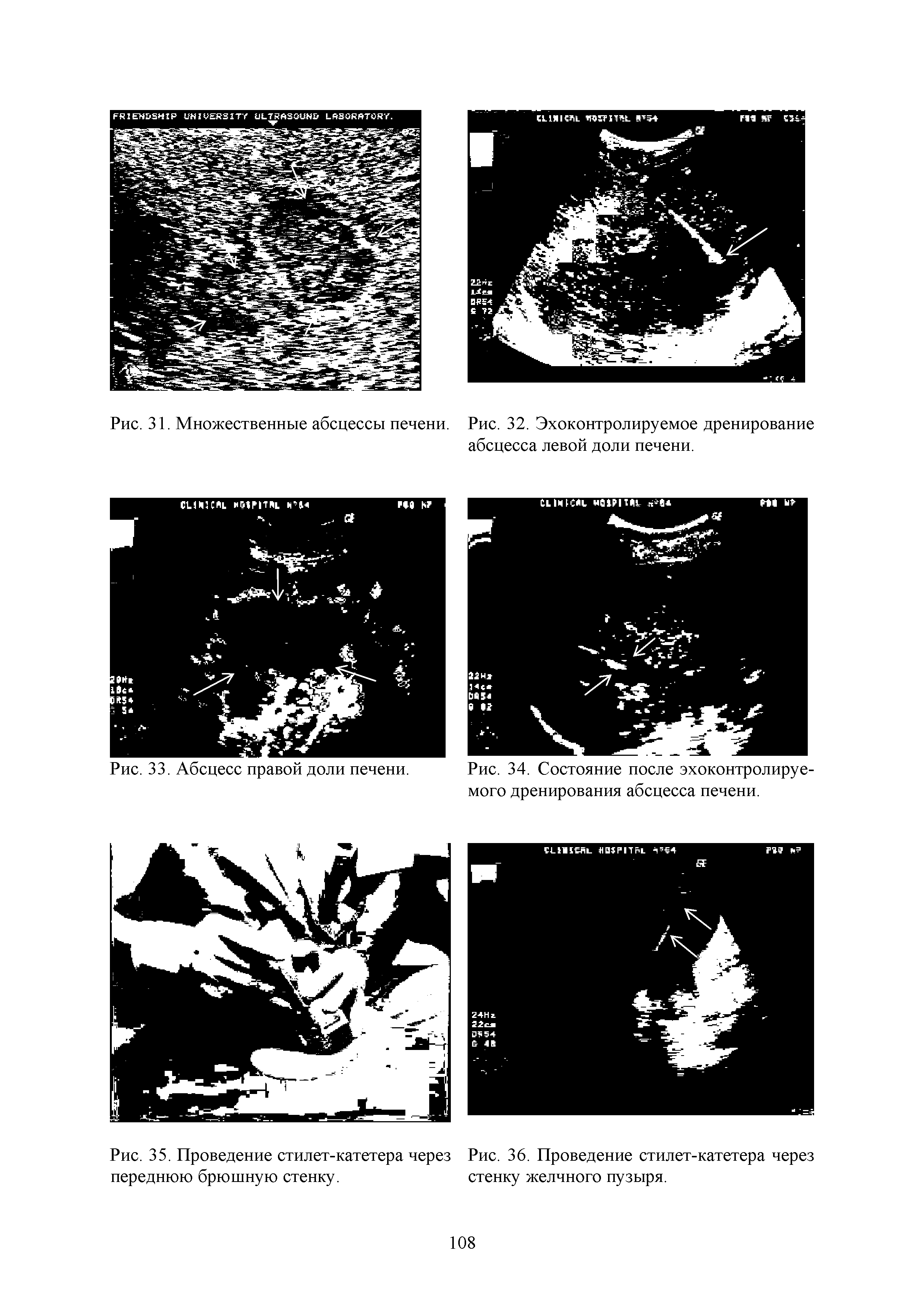 Рис. 35. Проведение стилет-катетера через Рис. 36. Проведение стилет-катетера через переднюю брюшную стенку. стенку желчного пузыря.