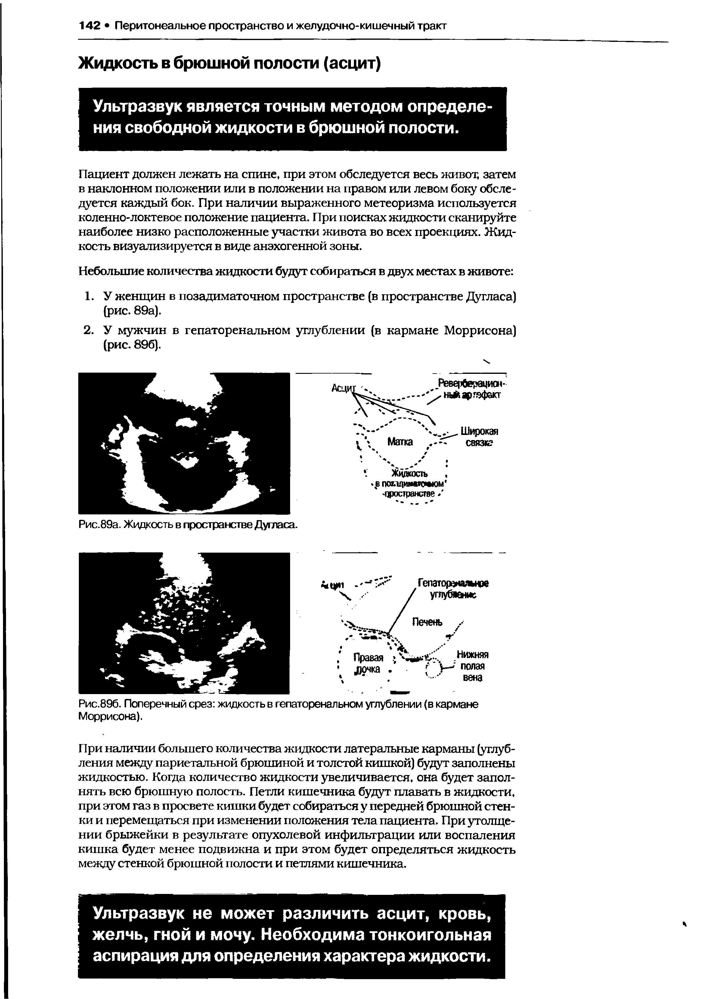 Рис.89б. Поперечный срез жидкость в гепаторенальном углублении (в кармане Моррисона).