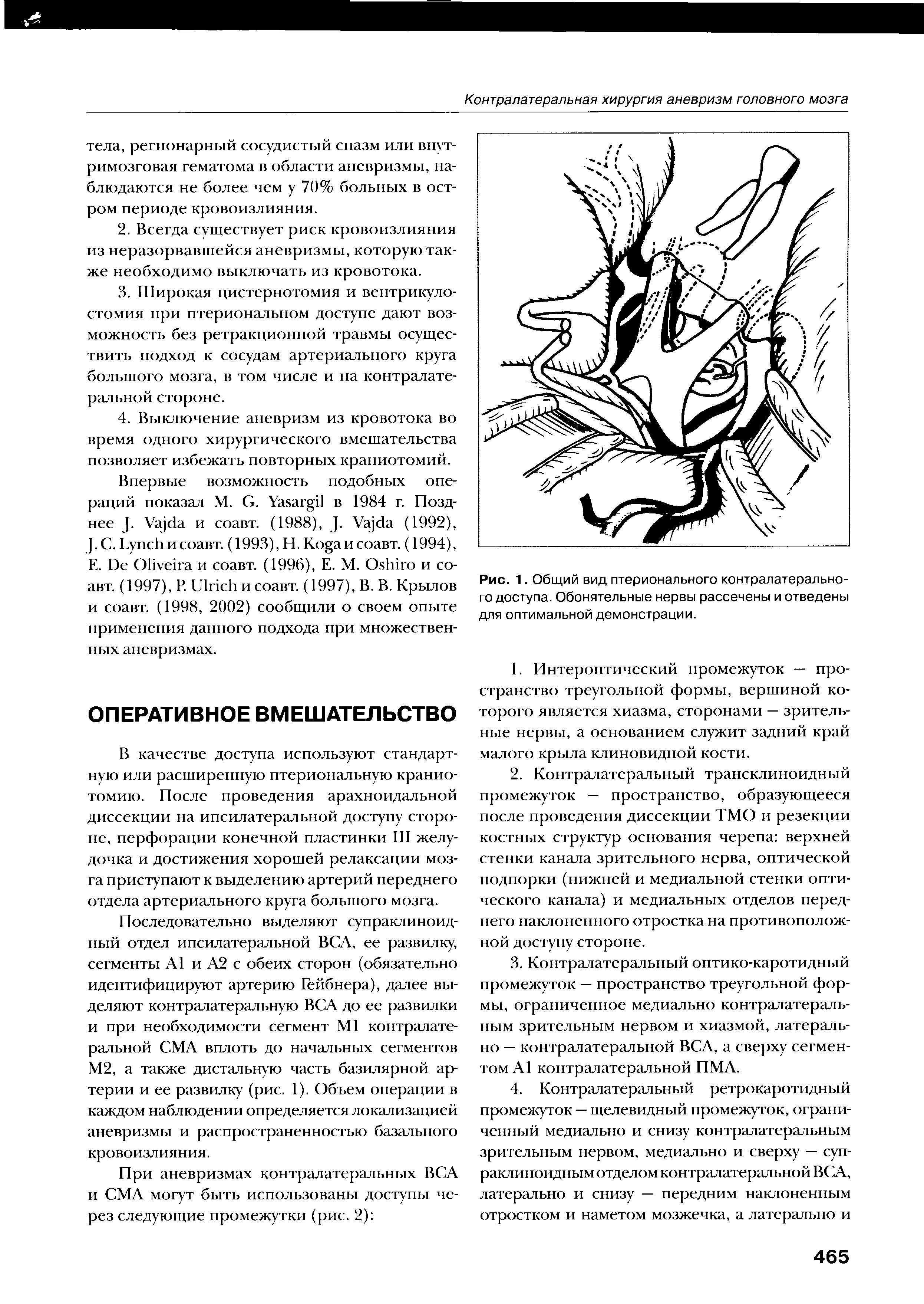 Рис. 1. Общий вид птерионального контралатерального доступа. Обонятельные нервы рассечены и отведены для оптимальной демонстрации.