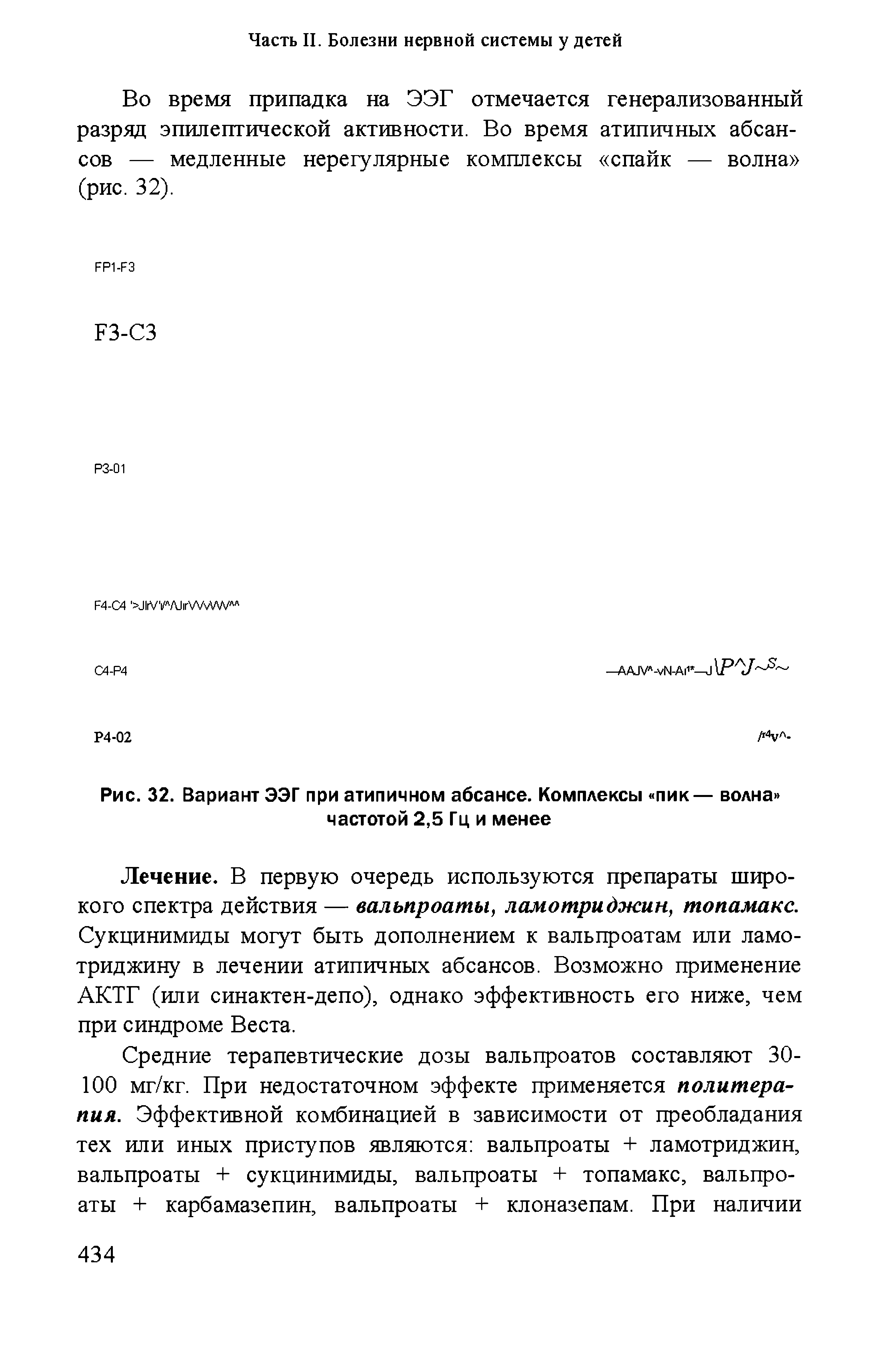 Рис. 32. Вариант ЭЭГ при атипичном абсансе. Комплексы пик— волна частотой 2,5 Гц и менее...