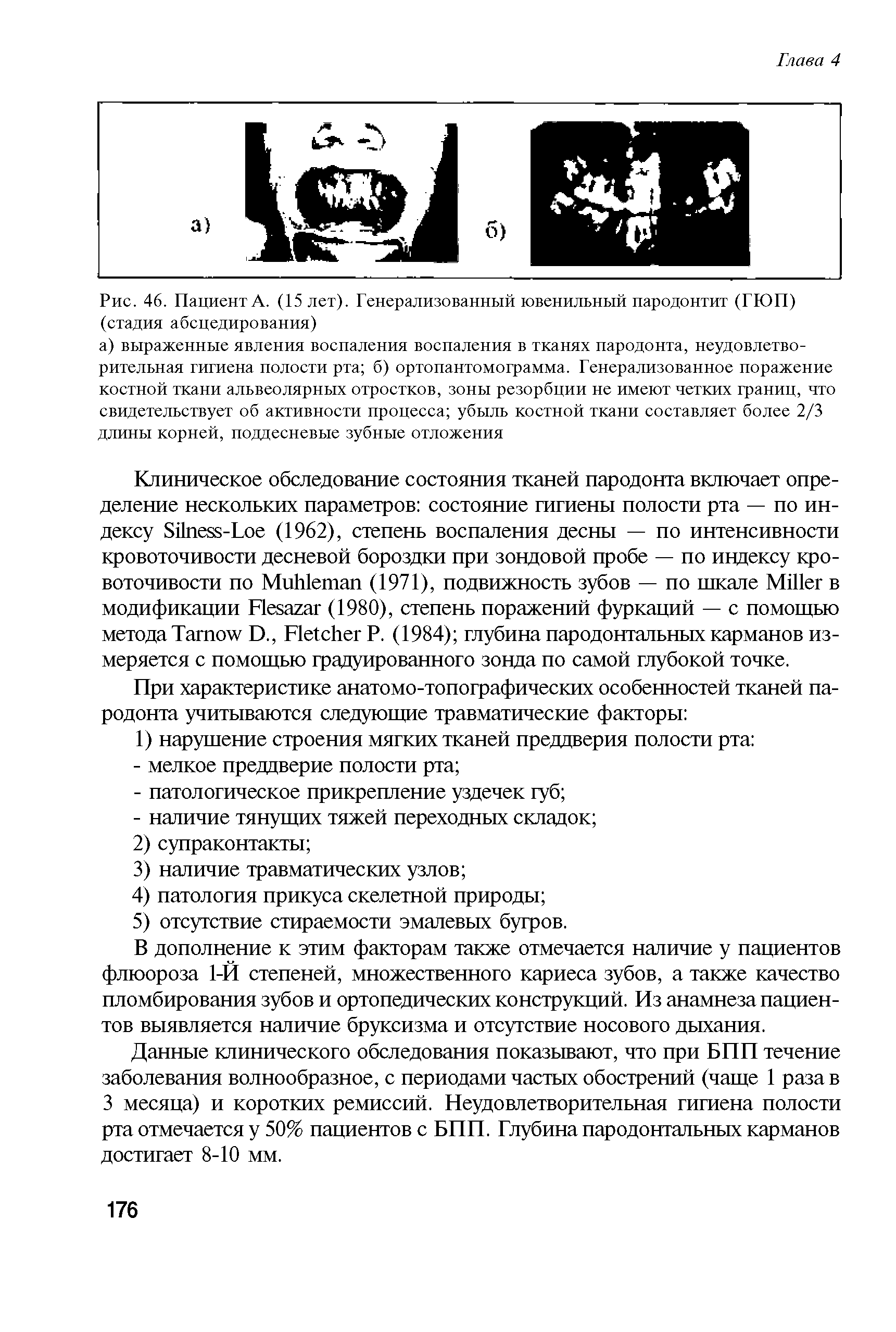 Рис. 46. Пациент А. (15 лет). Генерализованный ювенильный пародонтит (ГЮП) (стадия абсцедирования)...