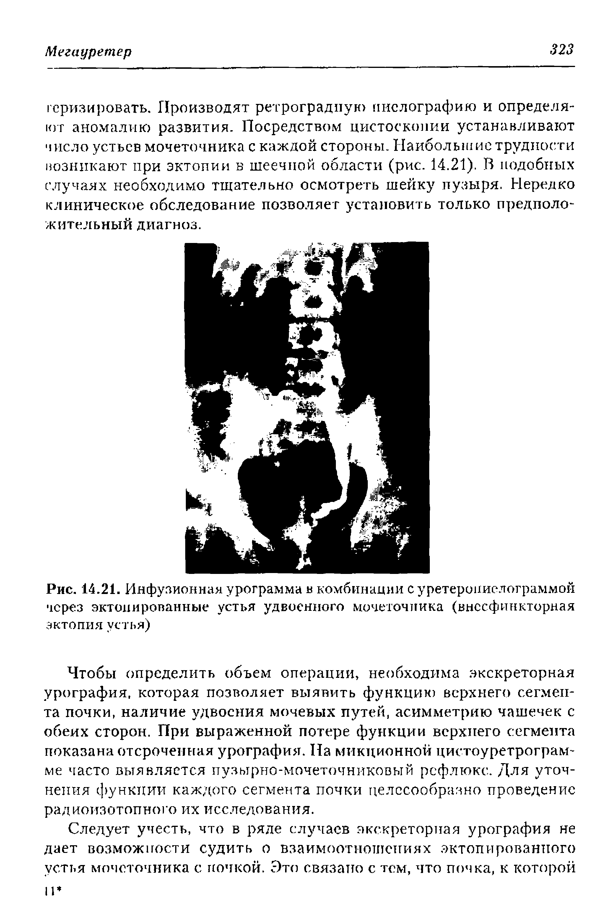 Рис. 14.21. Инфузионная урограмма в комбинации суретерониелограммой через эктопированные устья удвоенного мочеточника (внссфинкторная эктопия устья)...