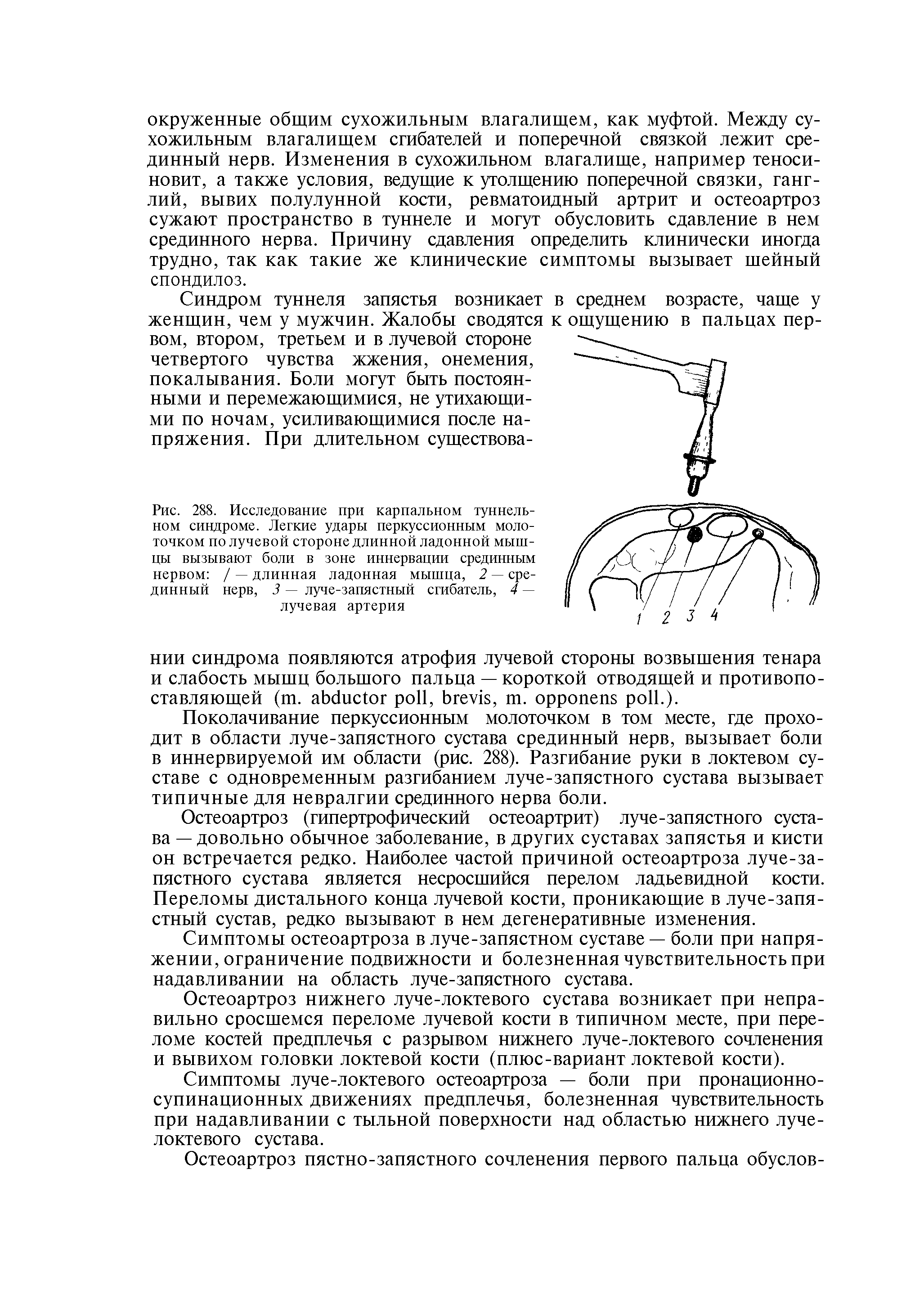 Рис. 288. Исследование при карпальном туннельном синдроме. Легкие удары перкуссионным молоточком по лучевой стороне длинной ладонной мышцы вызывают боли в зоне иннервации срединным нервом / — длинная ладонная мышца, 2 — срединный нерв, 3 — луче-запястный сгибатель, 4 — лучевая артерия...