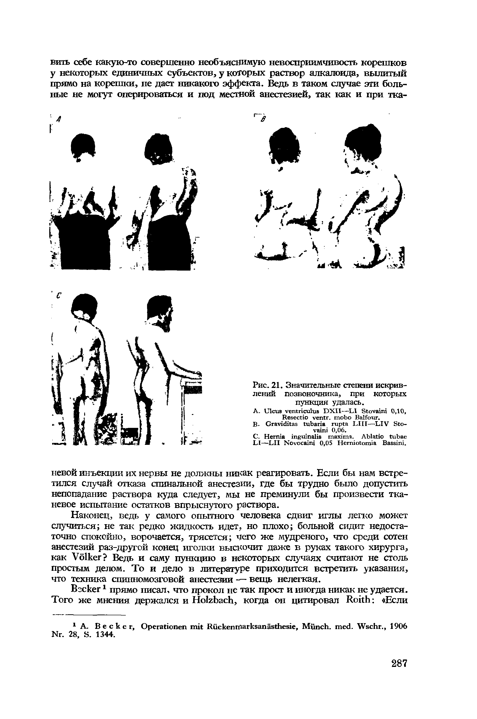 Рис. 21. Значительные степени искривлений позвоночника, при которых пункция удалась.