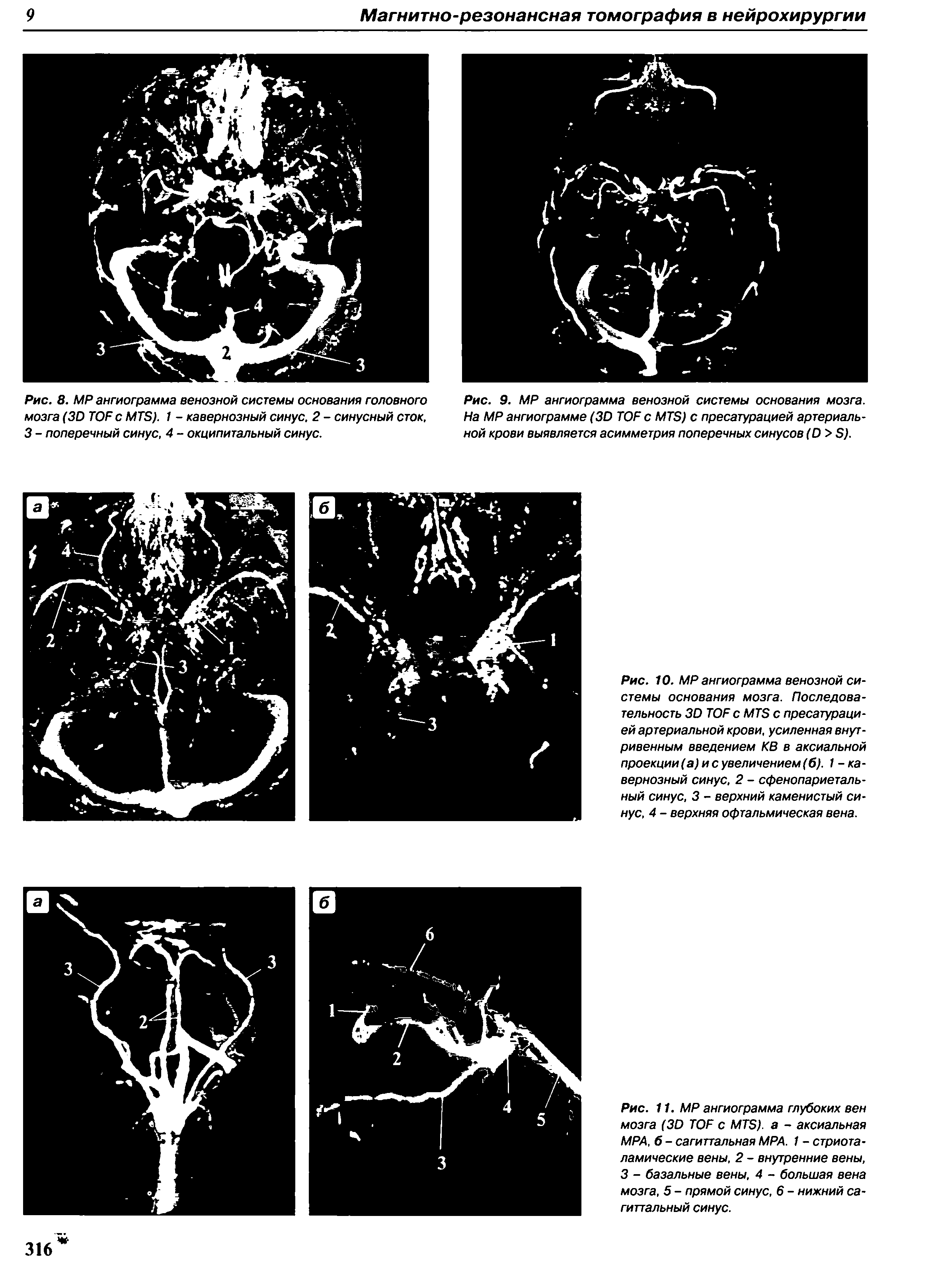 Рис. 8. МР ангиограмма венозной системы основания головного мозга (3D TOF с MTS). 1 - кавернозный синус, 2 - синусный сток, 3 - поперечный синус, 4 - окципитальный синус.