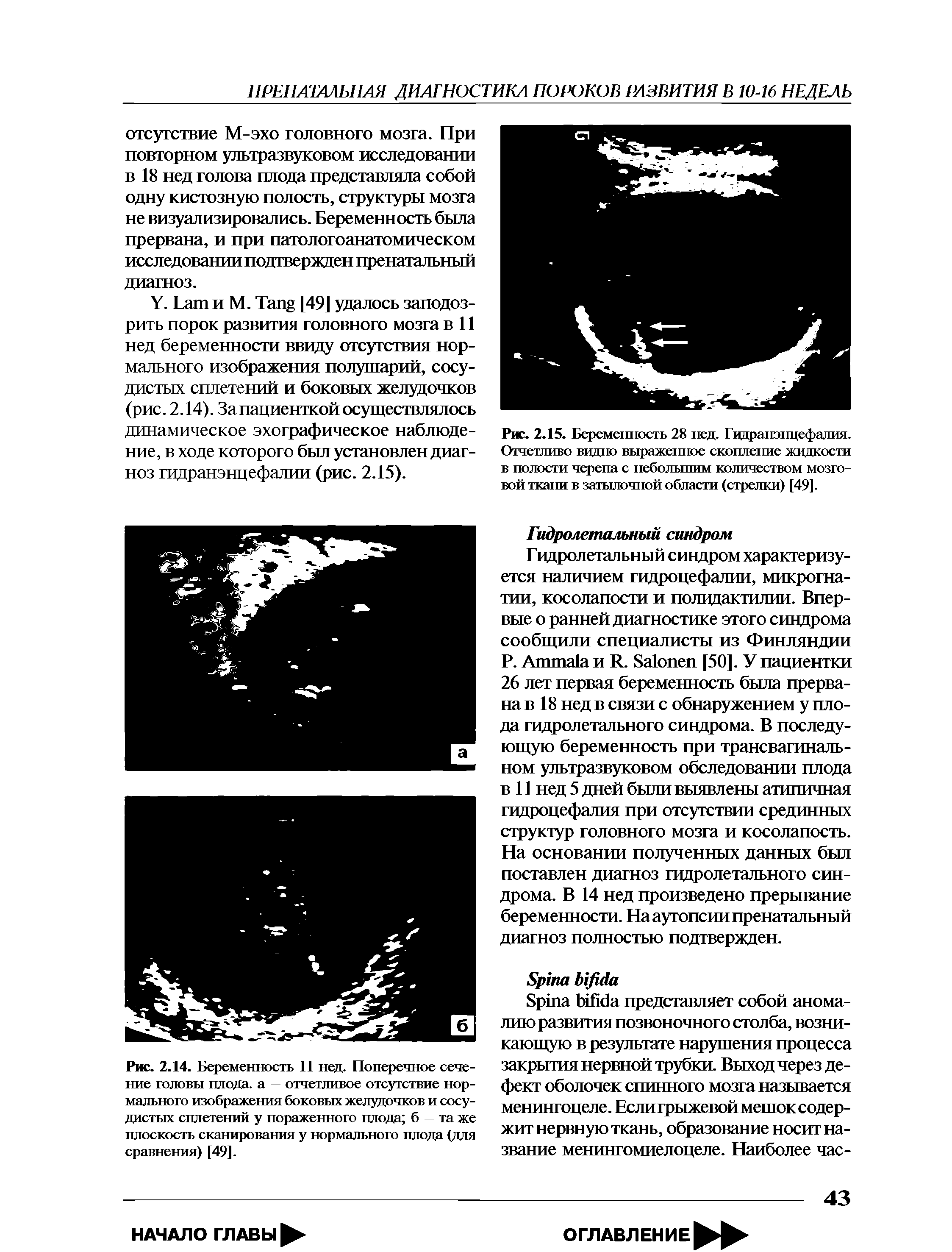 Рис. 2.14. Беременность 11 нед. Поперечное сечение головы плода, а отчетливое отсутствие нормального изображения боковых желудочков и сосудистых сплетений у пораженного плода б та же плоскость сканирования у нормального плода (для сравнения) [49].